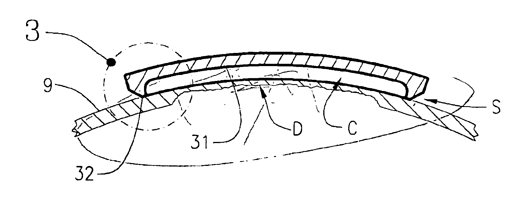 Local degraded area repair and restoration component for pressure retaining items