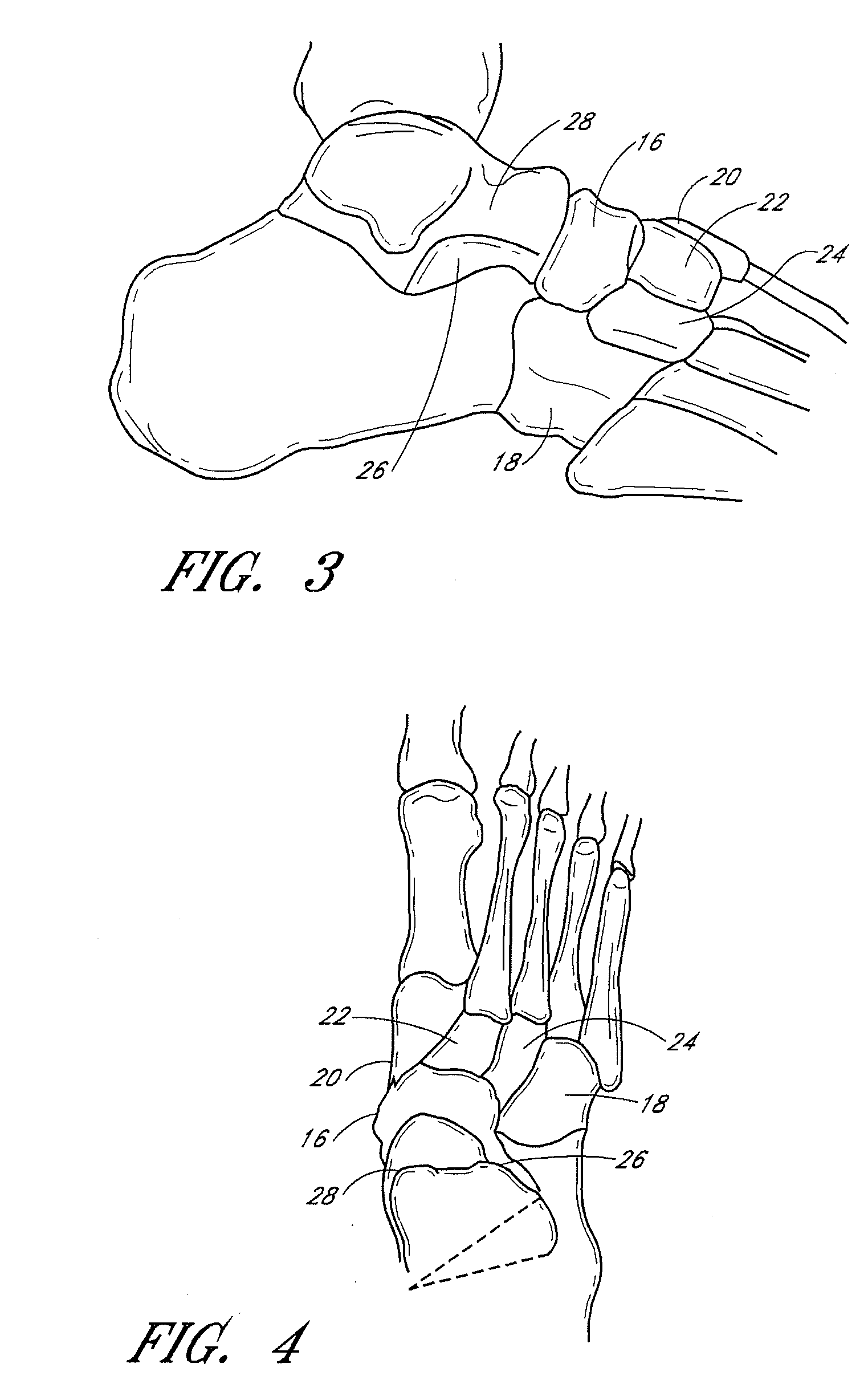 Catheter deliverable foot implant and method of delivering the same