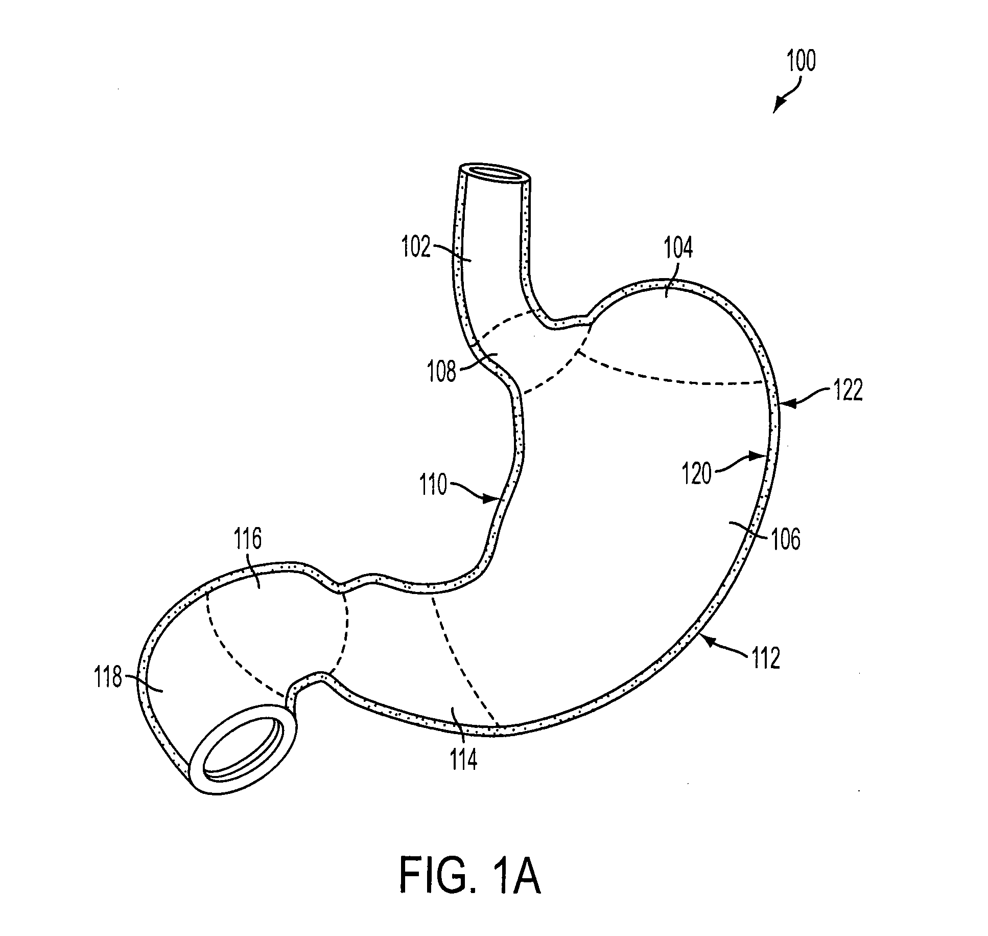 Gastric restriction devices with fillable chambers and ablation means for treating obesity