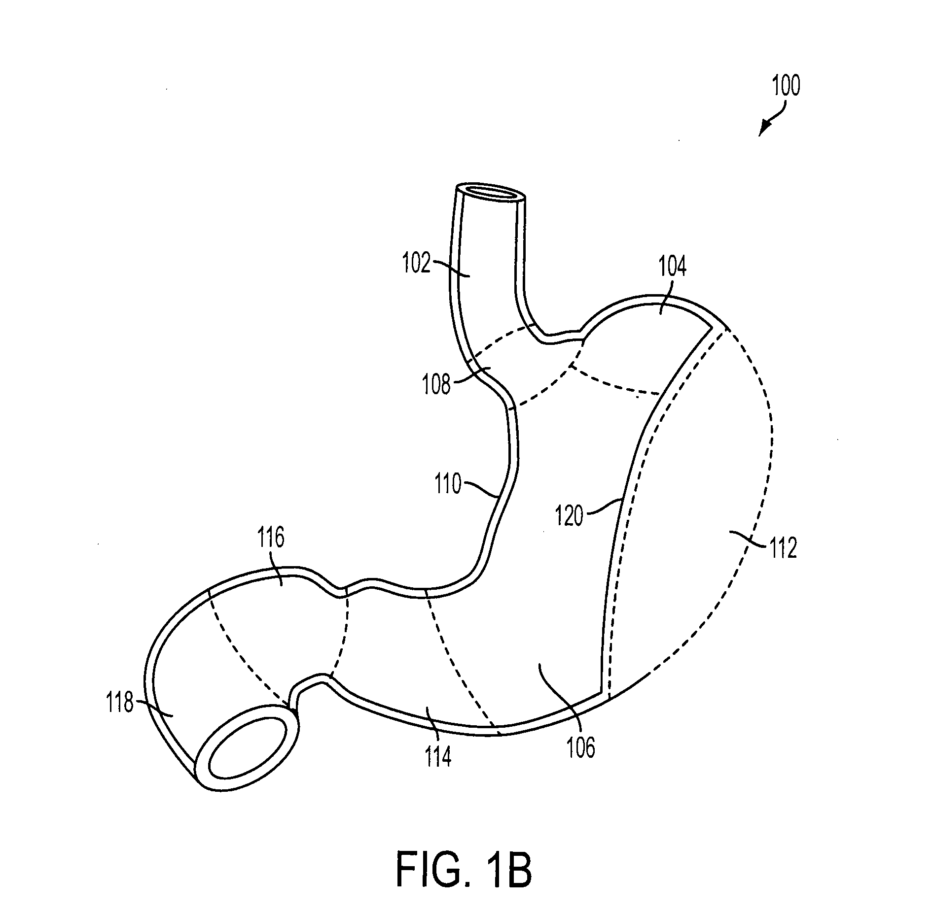 Gastric restriction devices with fillable chambers and ablation means for treating obesity