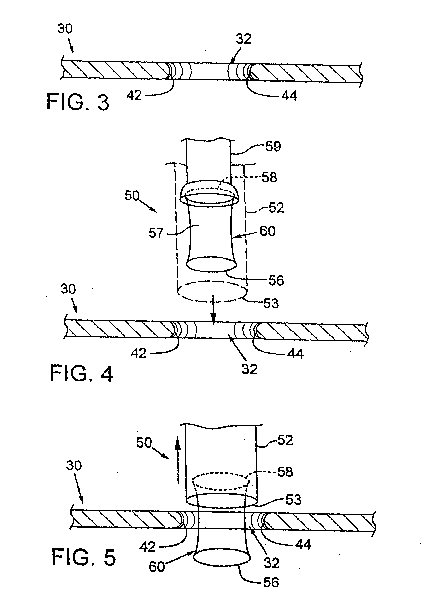 Interfacial stent and method of maintaining patency of surgical fenestrations