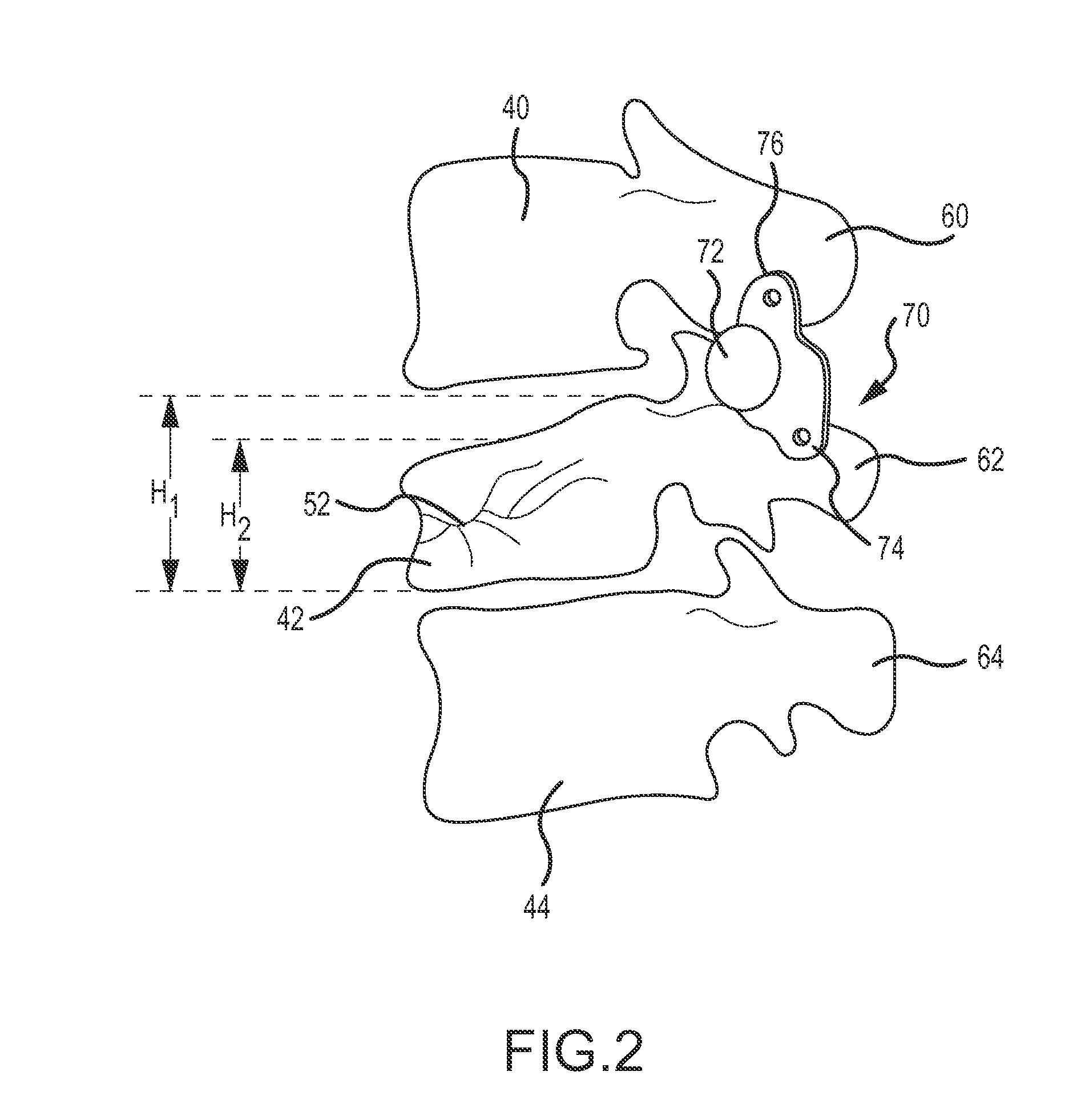 Methods for compression fracture treatment with spinous process fixation systems