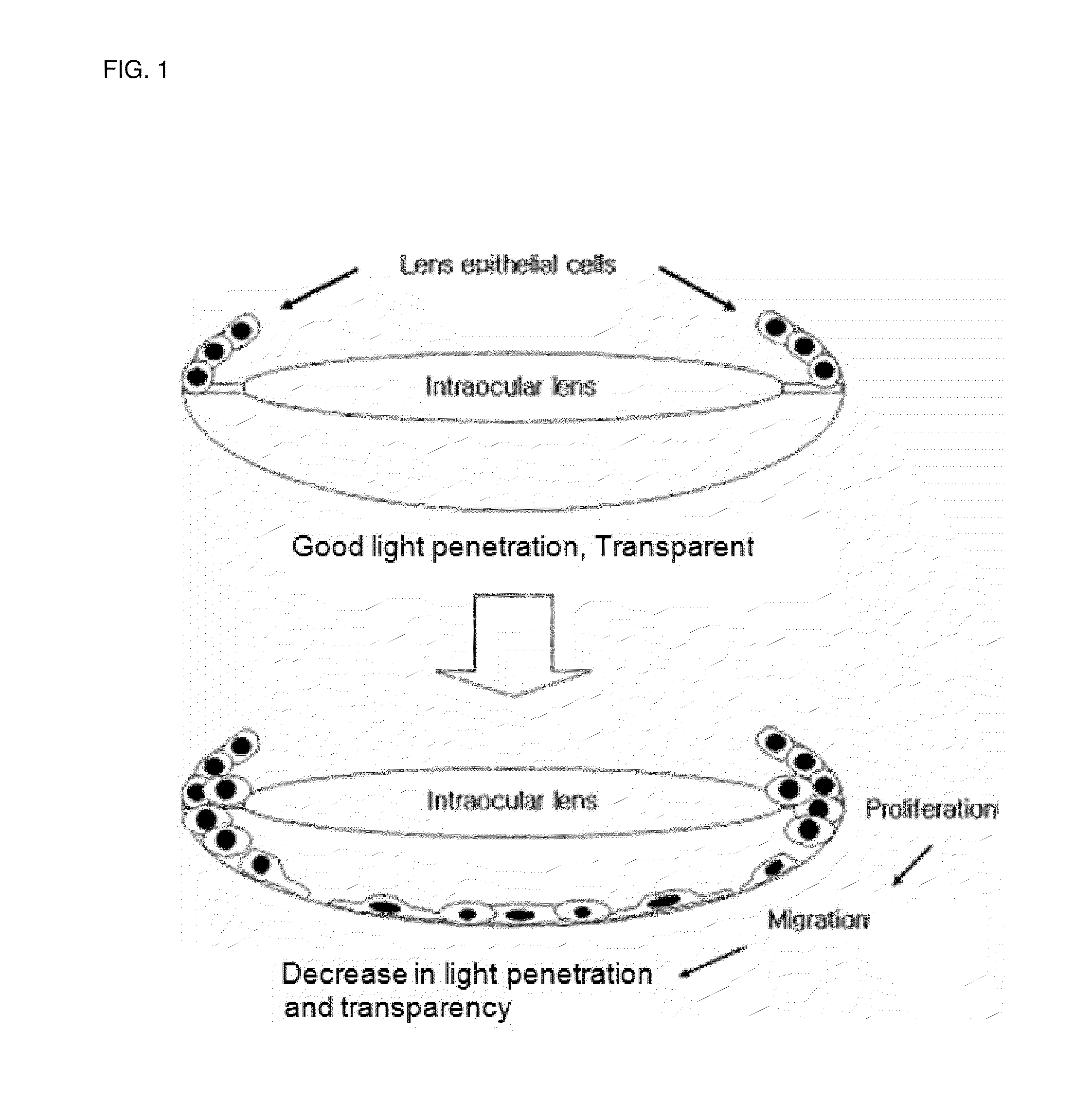 Composition for inhibiting after-cataract and method of preparing the same