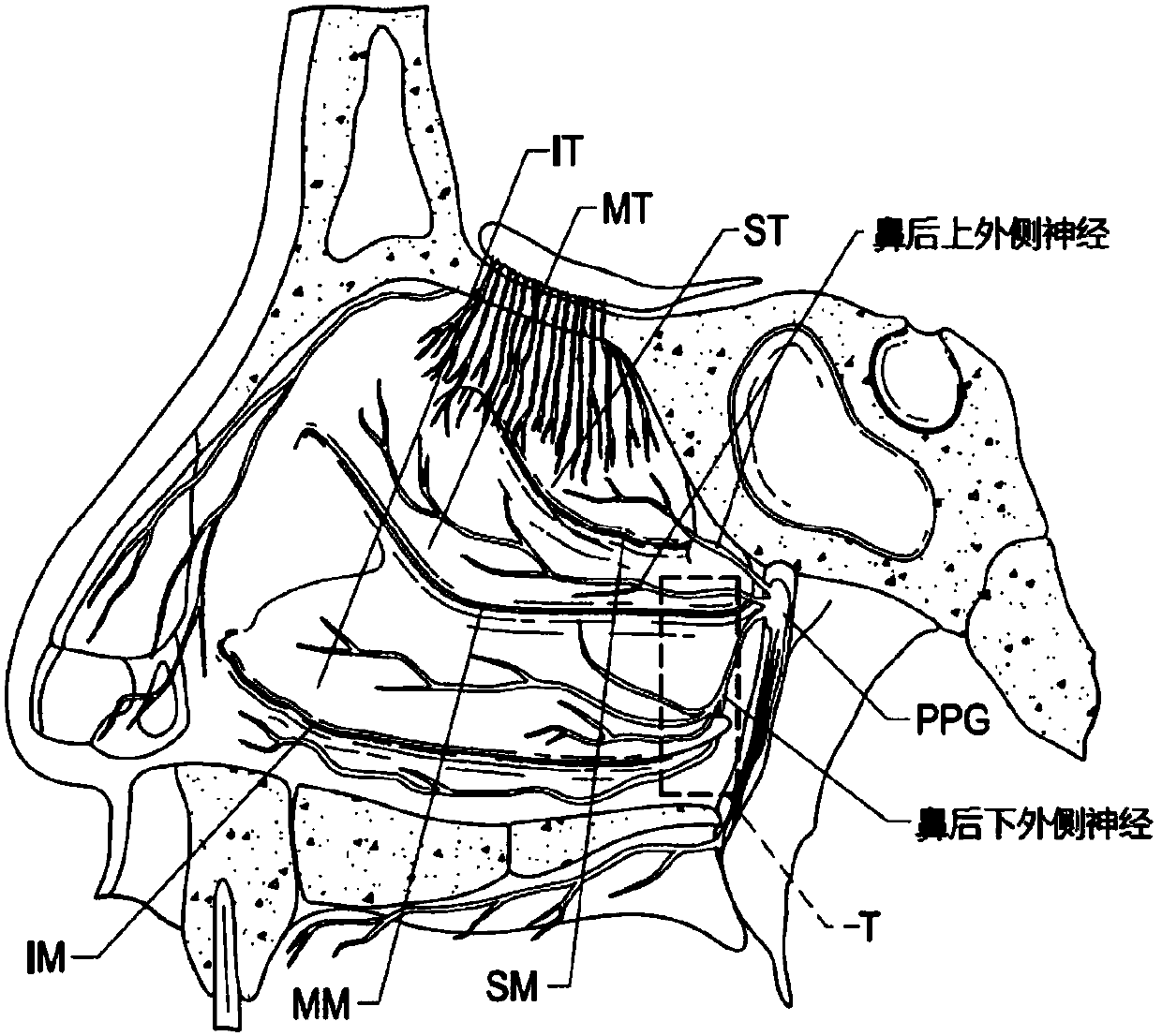 Devices for therapeutic nasal neuromodulation and associated methods and systems