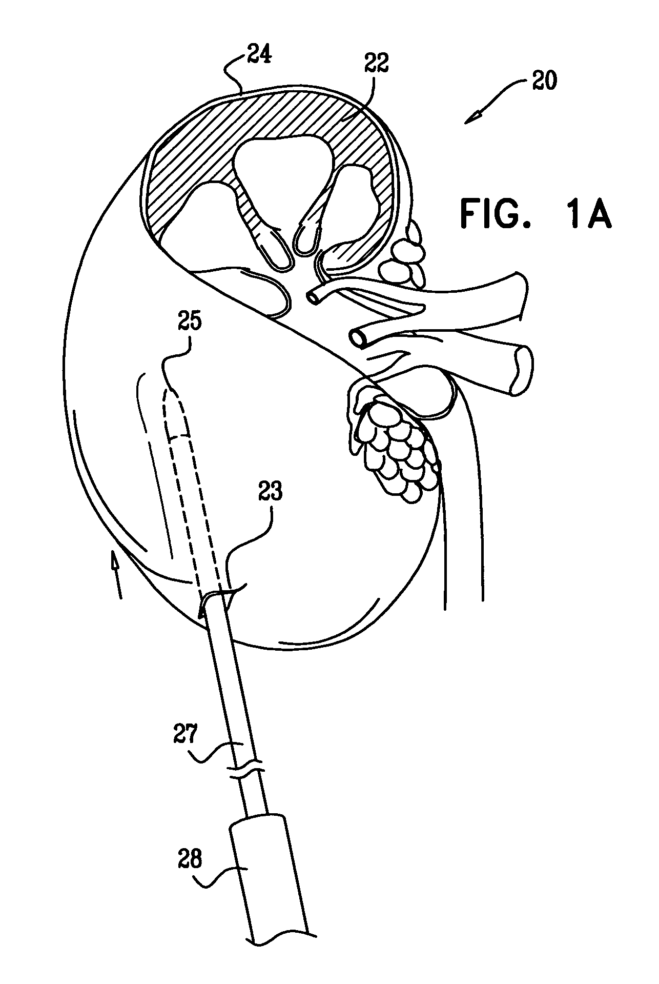 Optimization of alginate encapsulation of islets for transplantation