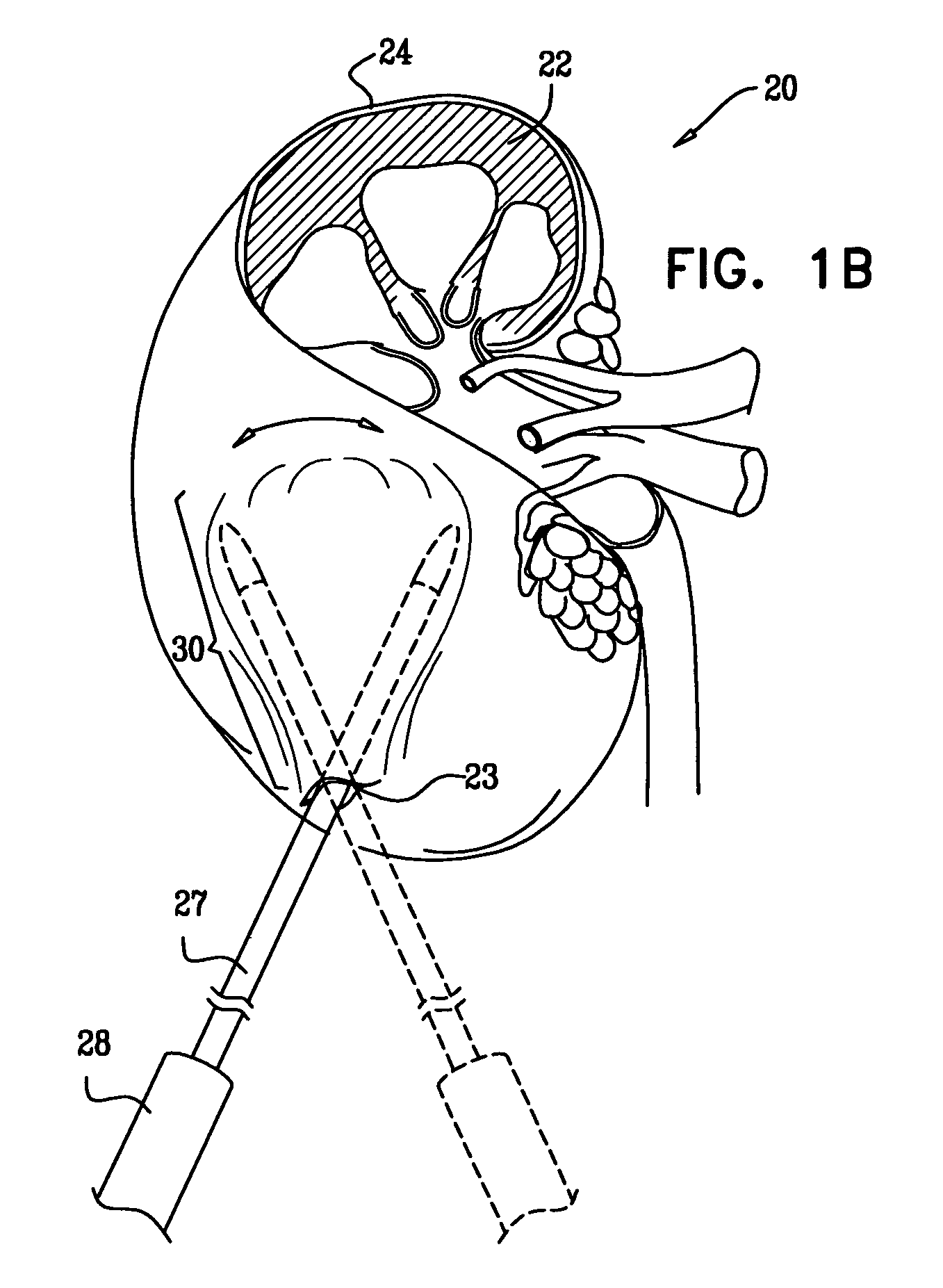 Optimization of alginate encapsulation of islets for transplantation