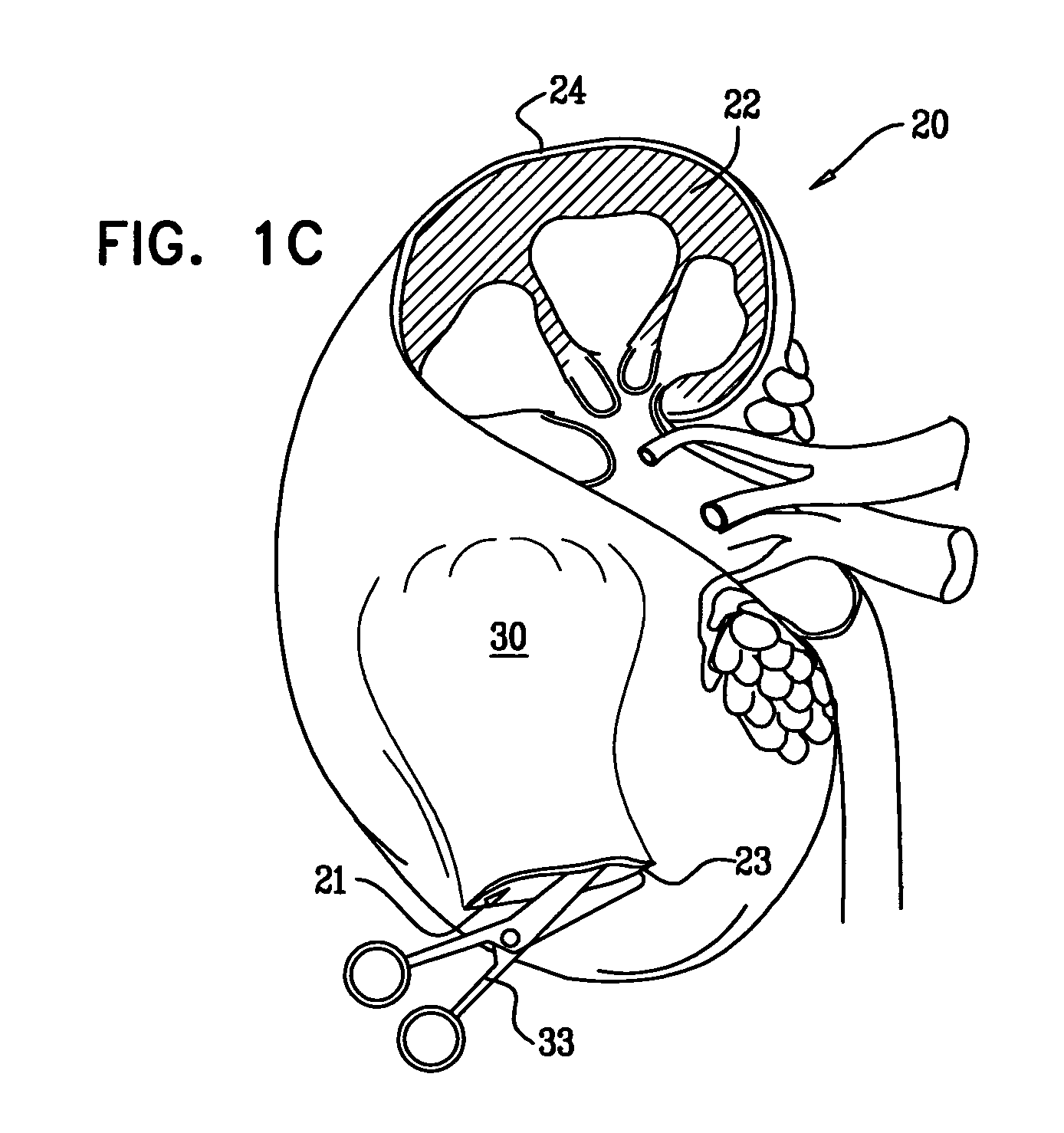 Optimization of alginate encapsulation of islets for transplantation