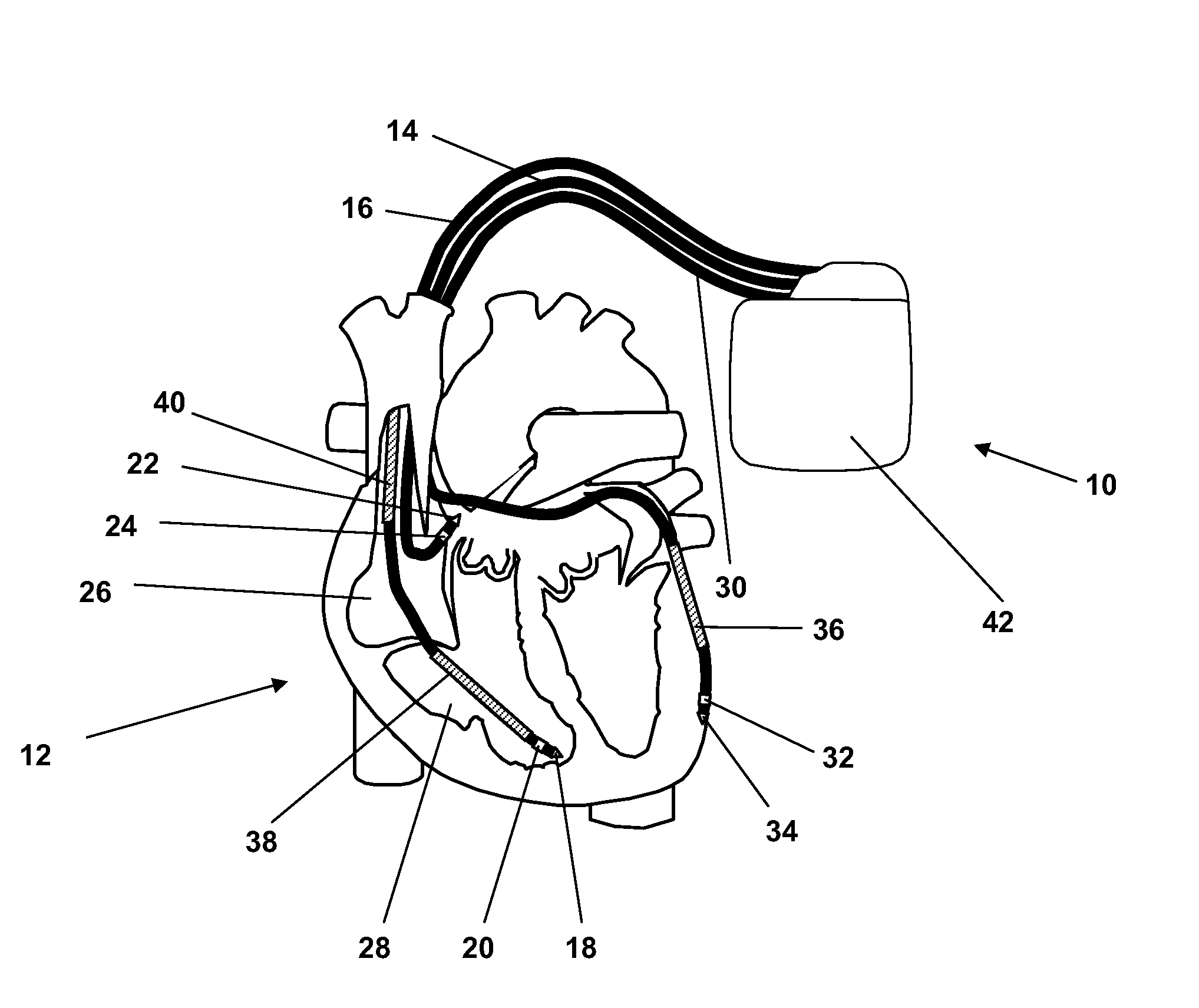 Implantable medical devices evaluating thorax impedance