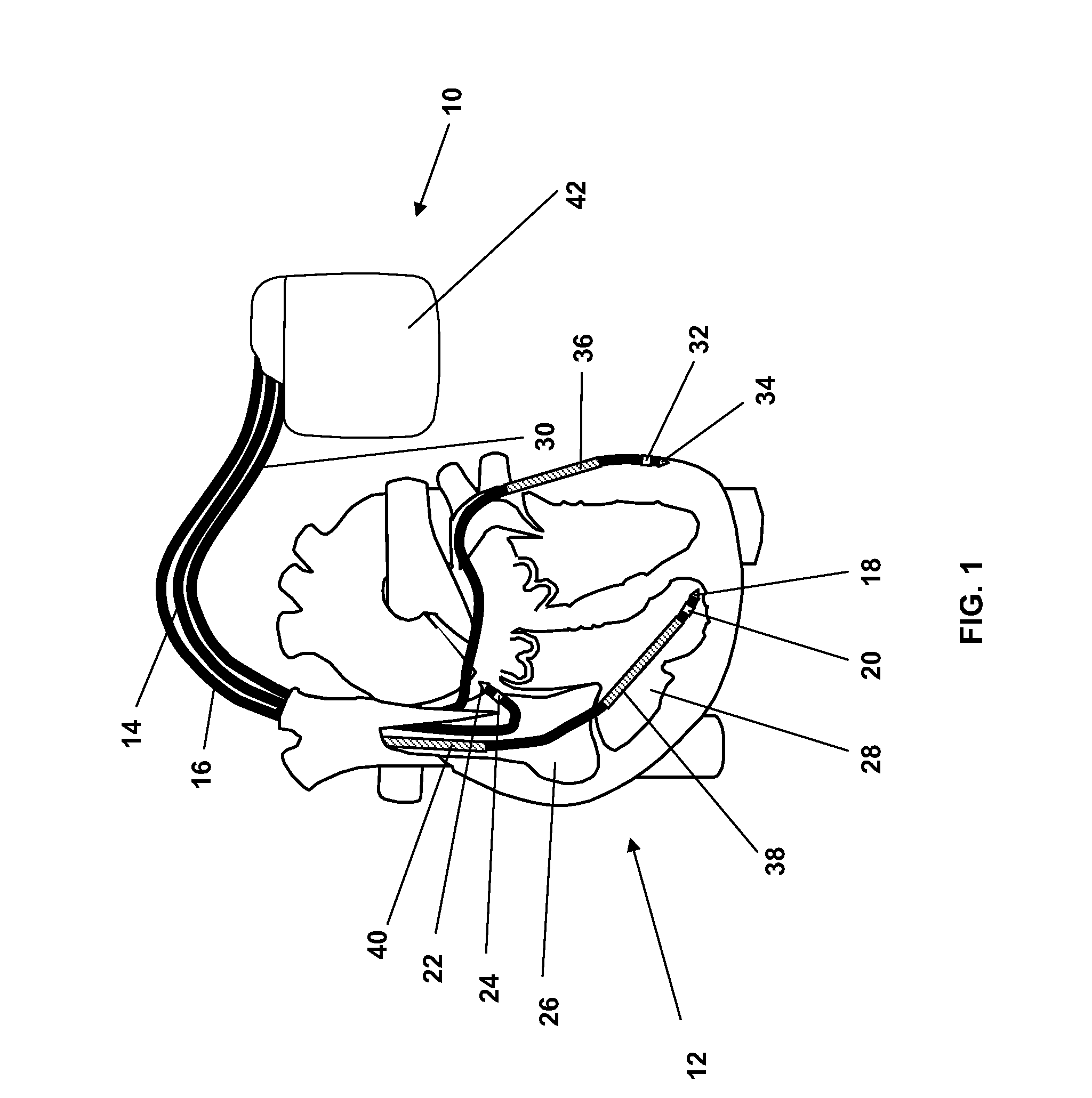 Implantable medical devices evaluating thorax impedance