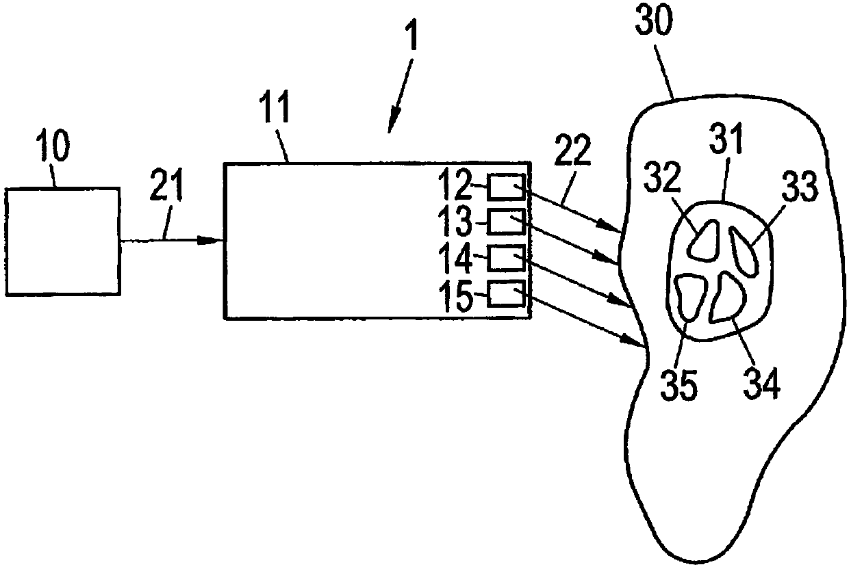 Device and method for effective invasive two-stage neurostimulation