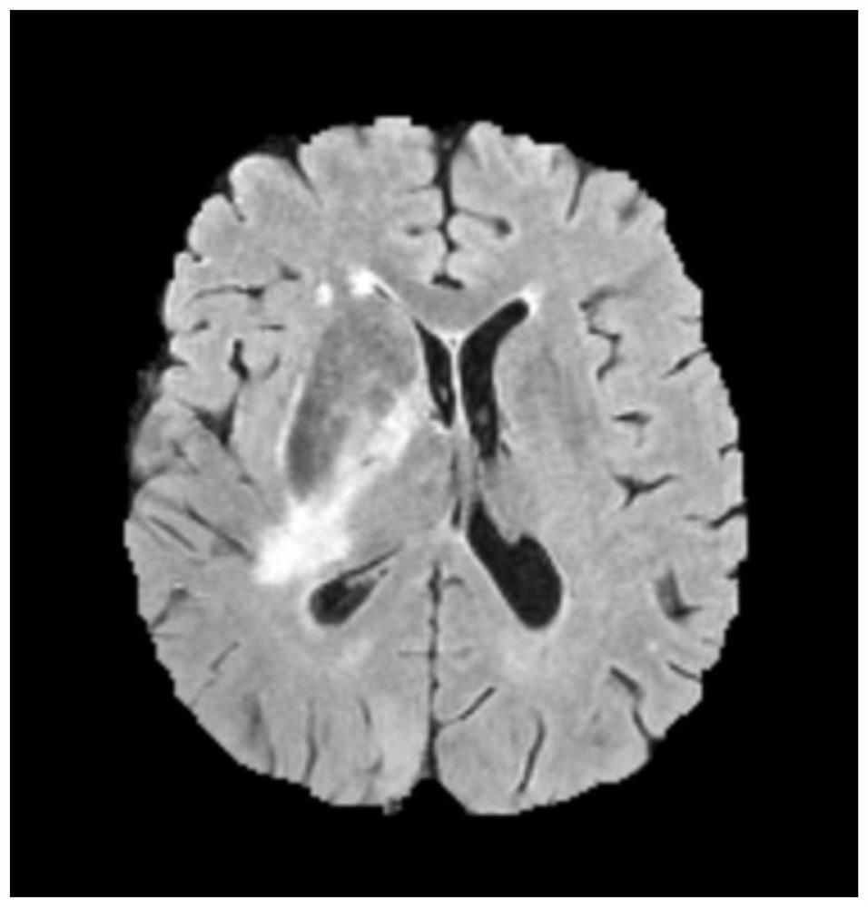 An MRI brain tumor image segmentation method based on dbn neural network