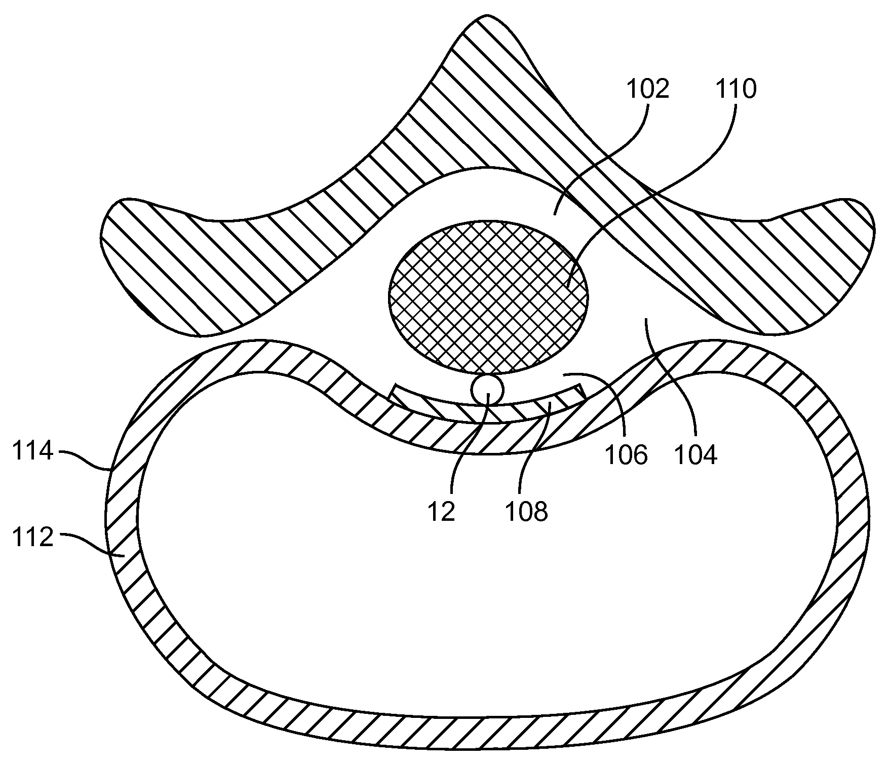 System and method for electrical modulation of the posterior Longitudinal ligament