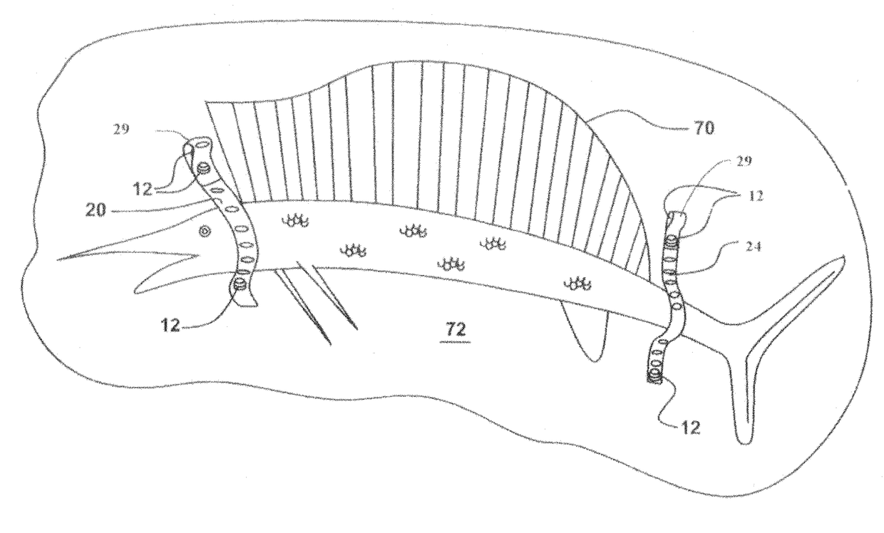 Flexible support and closureapparatus