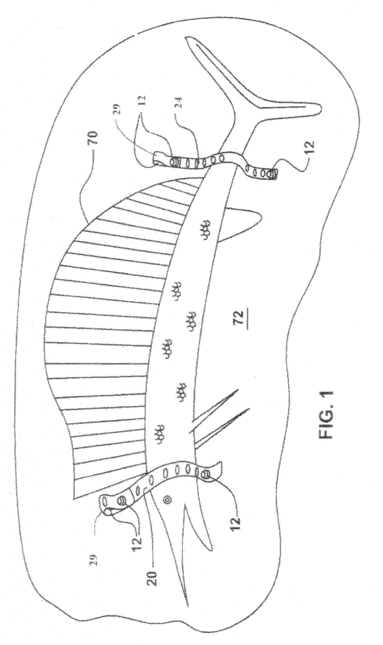 Flexible support and closureapparatus