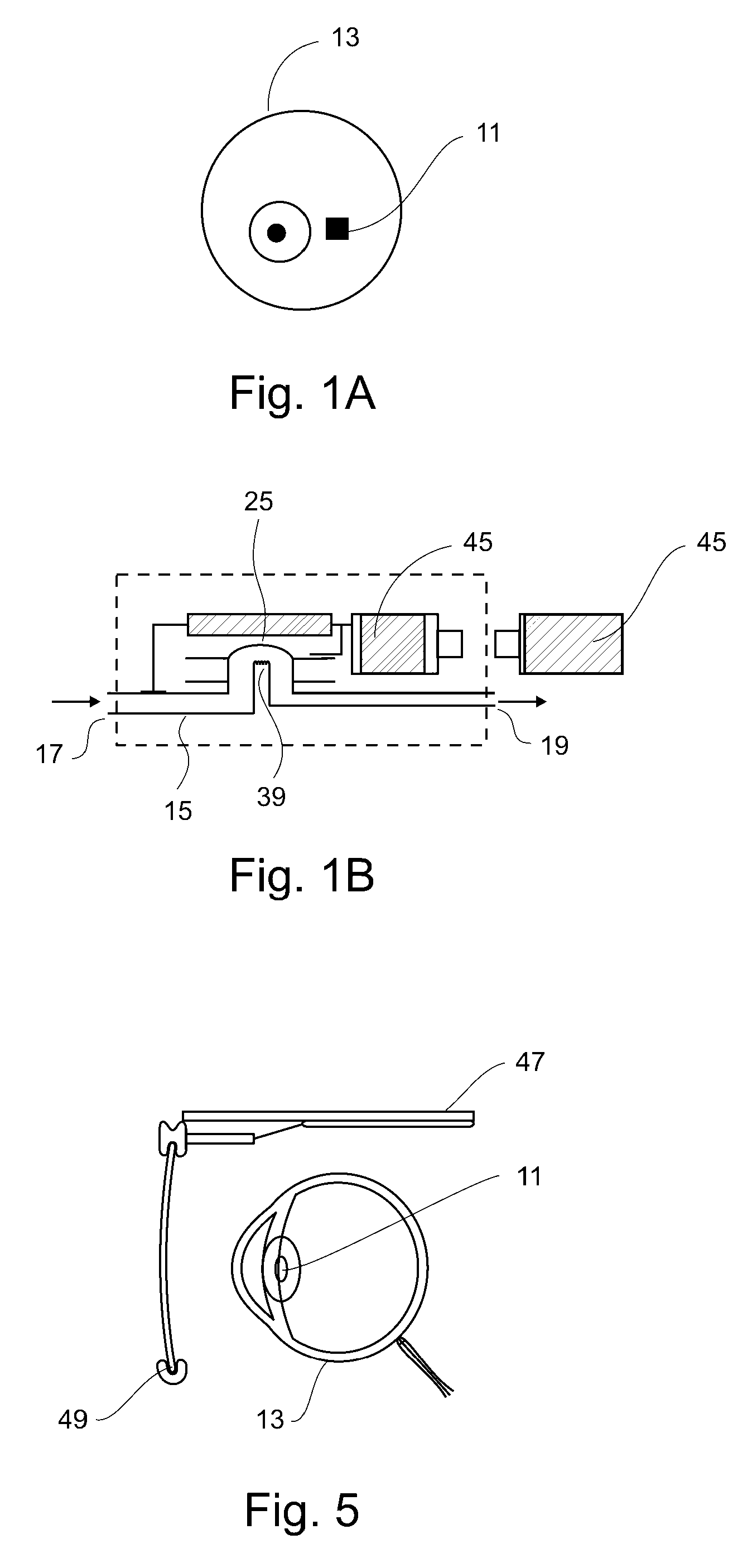 Implantable ocular microapparatus to ameliorate glaucoma or an ocular overpressure causing disease