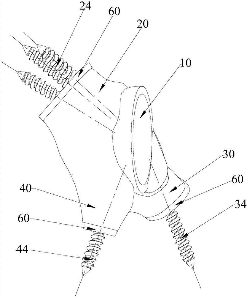 Peri-acetabular prosthesis structure