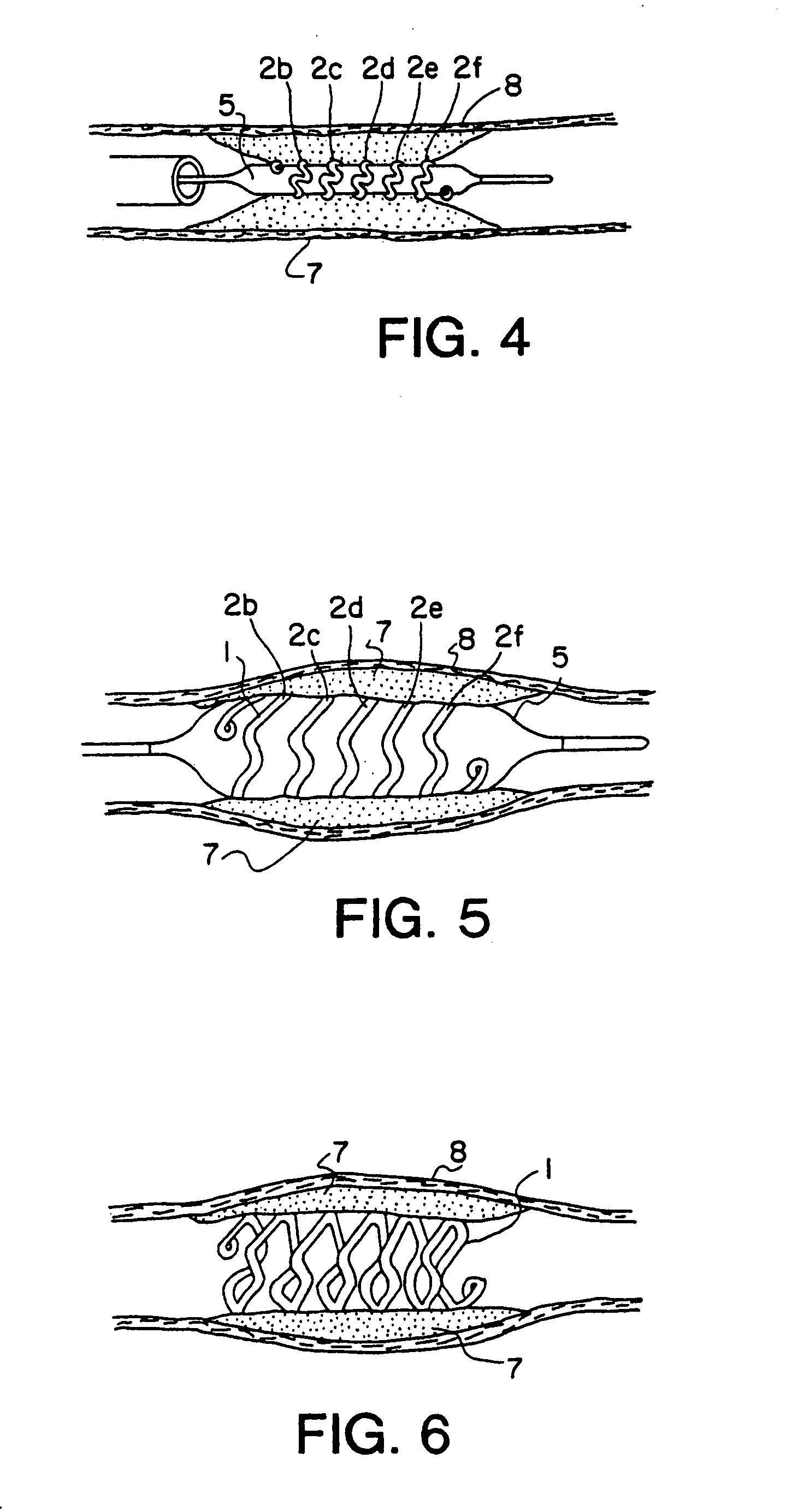 Intravascular stent