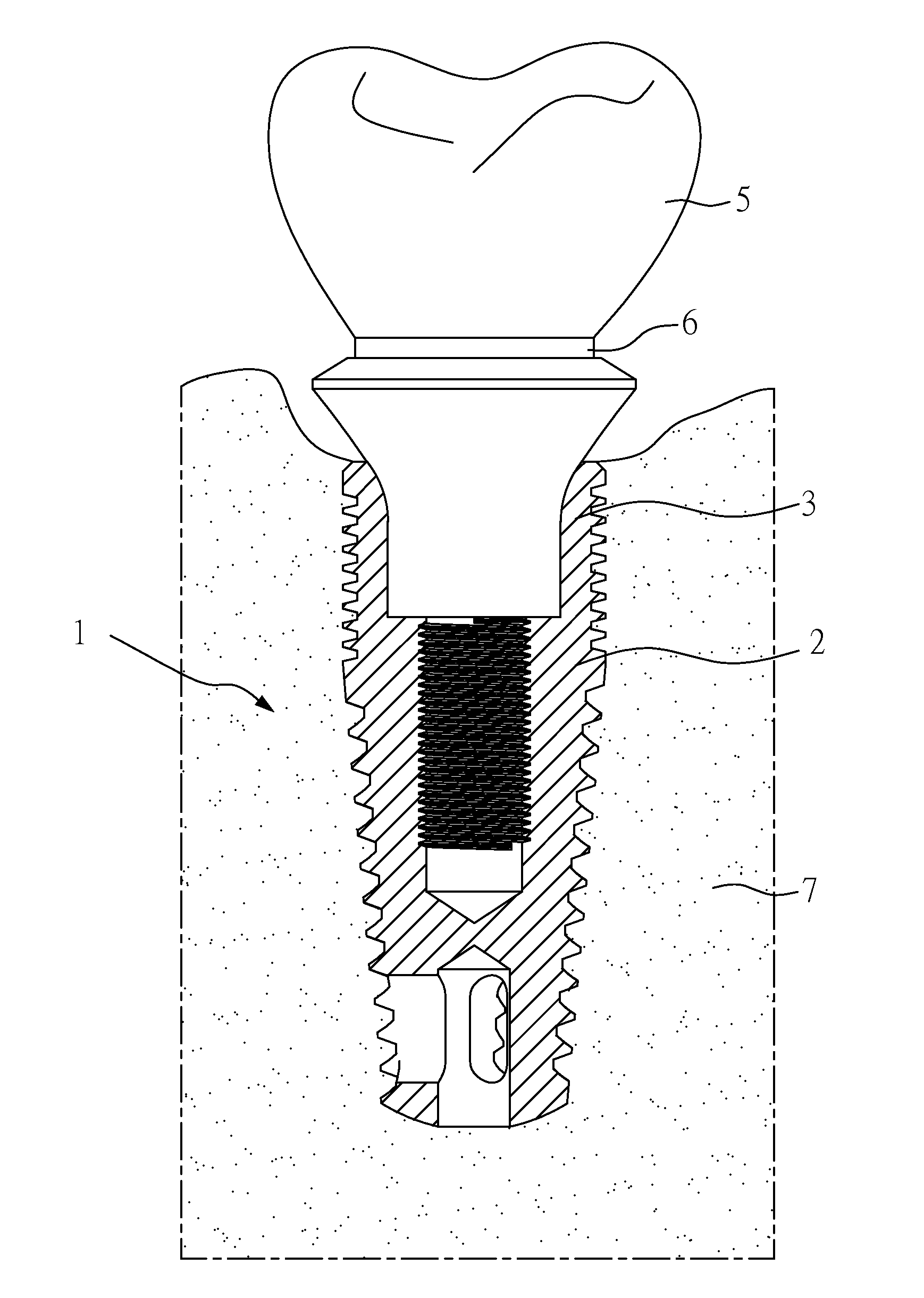 Tooth-Replacement Implant