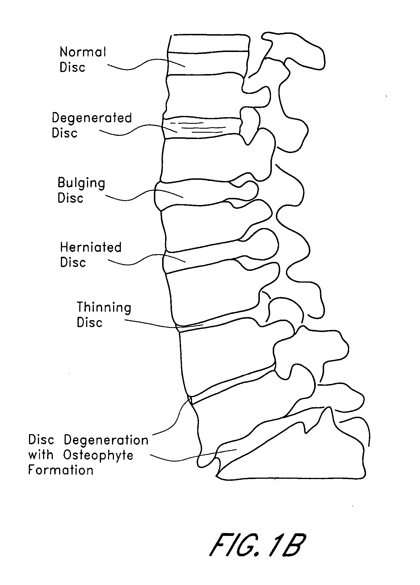 Method and apparatus for introducing material along an access path to a treatment site