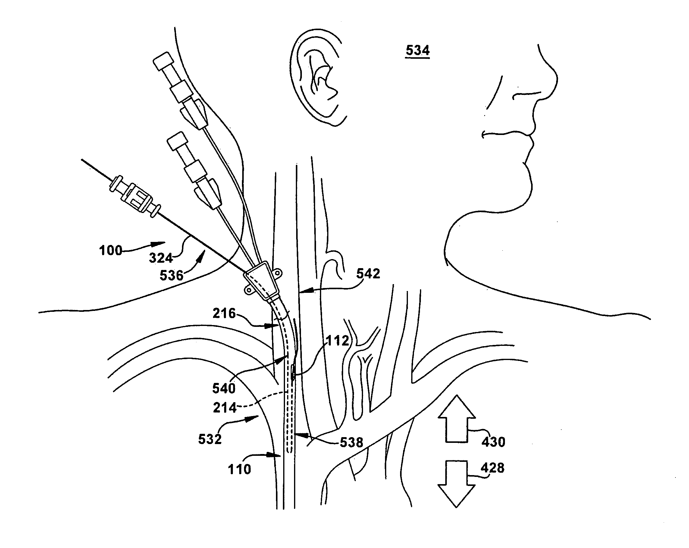 Intrajugular catheter