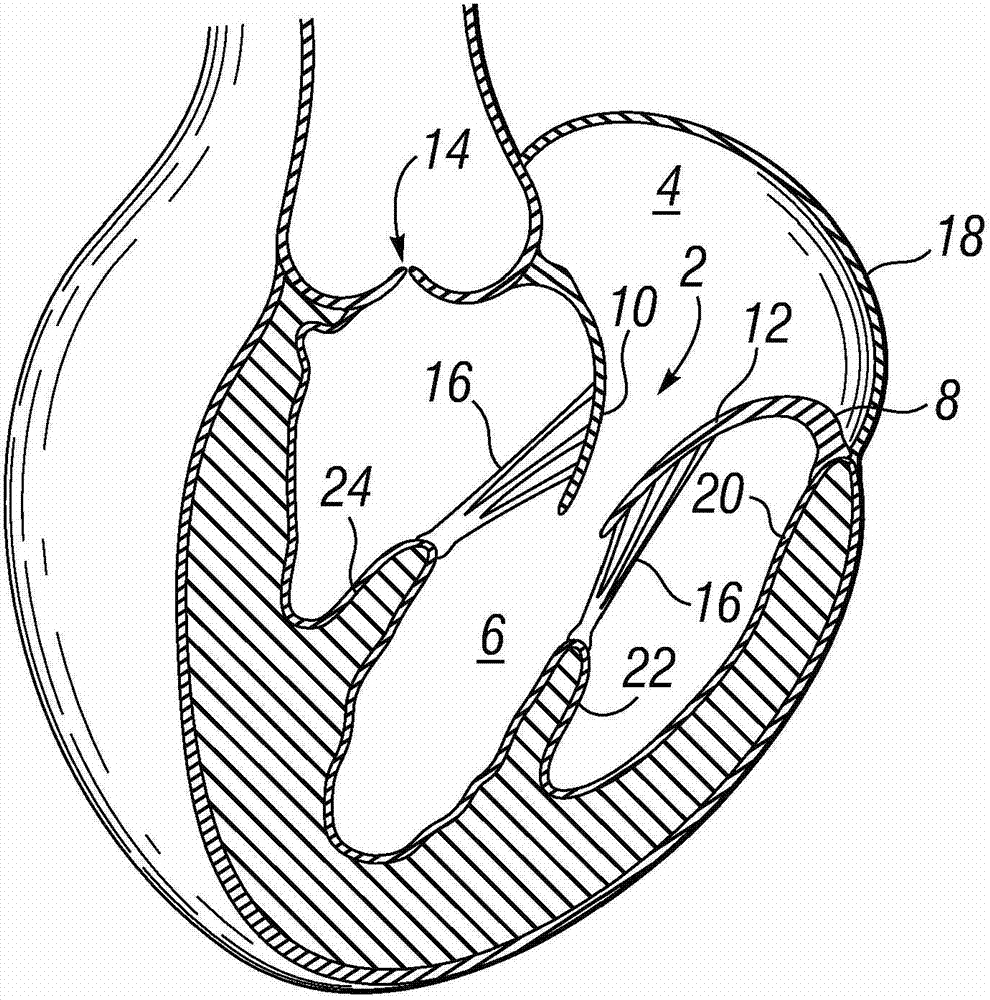 Prosthetic valve used to replace the mitral valve