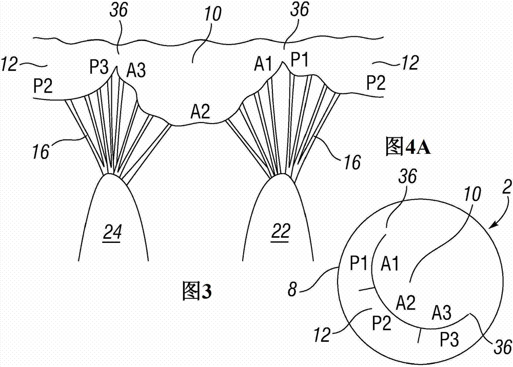 Prosthetic valve used to replace the mitral valve