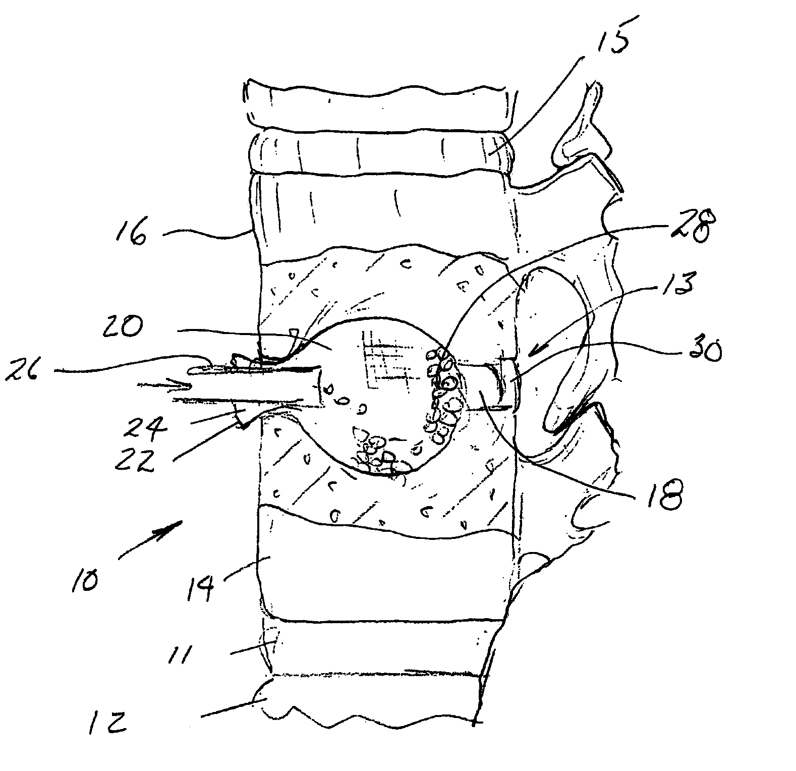 Packable ceramic beads for bone repair