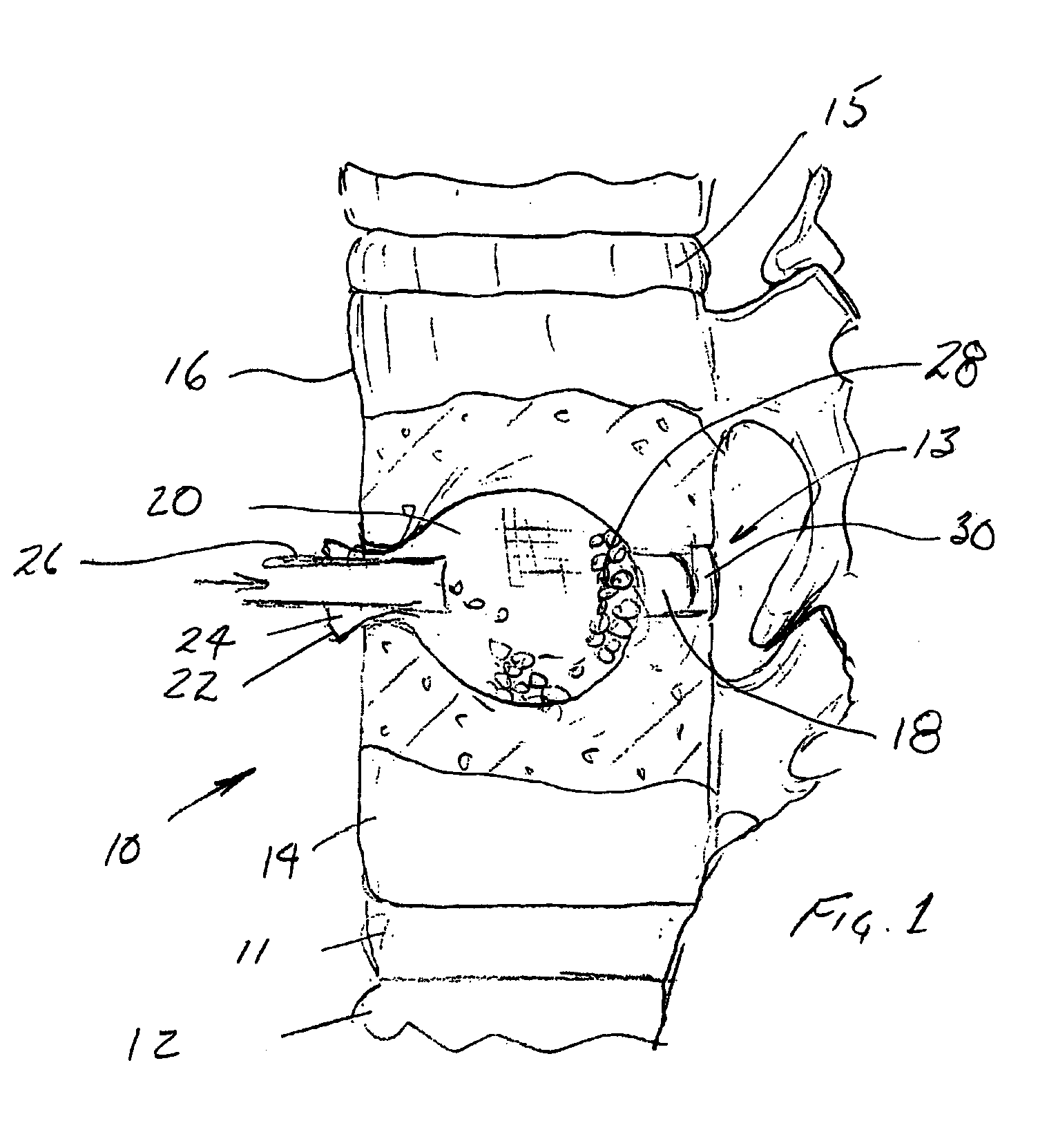 Packable ceramic beads for bone repair