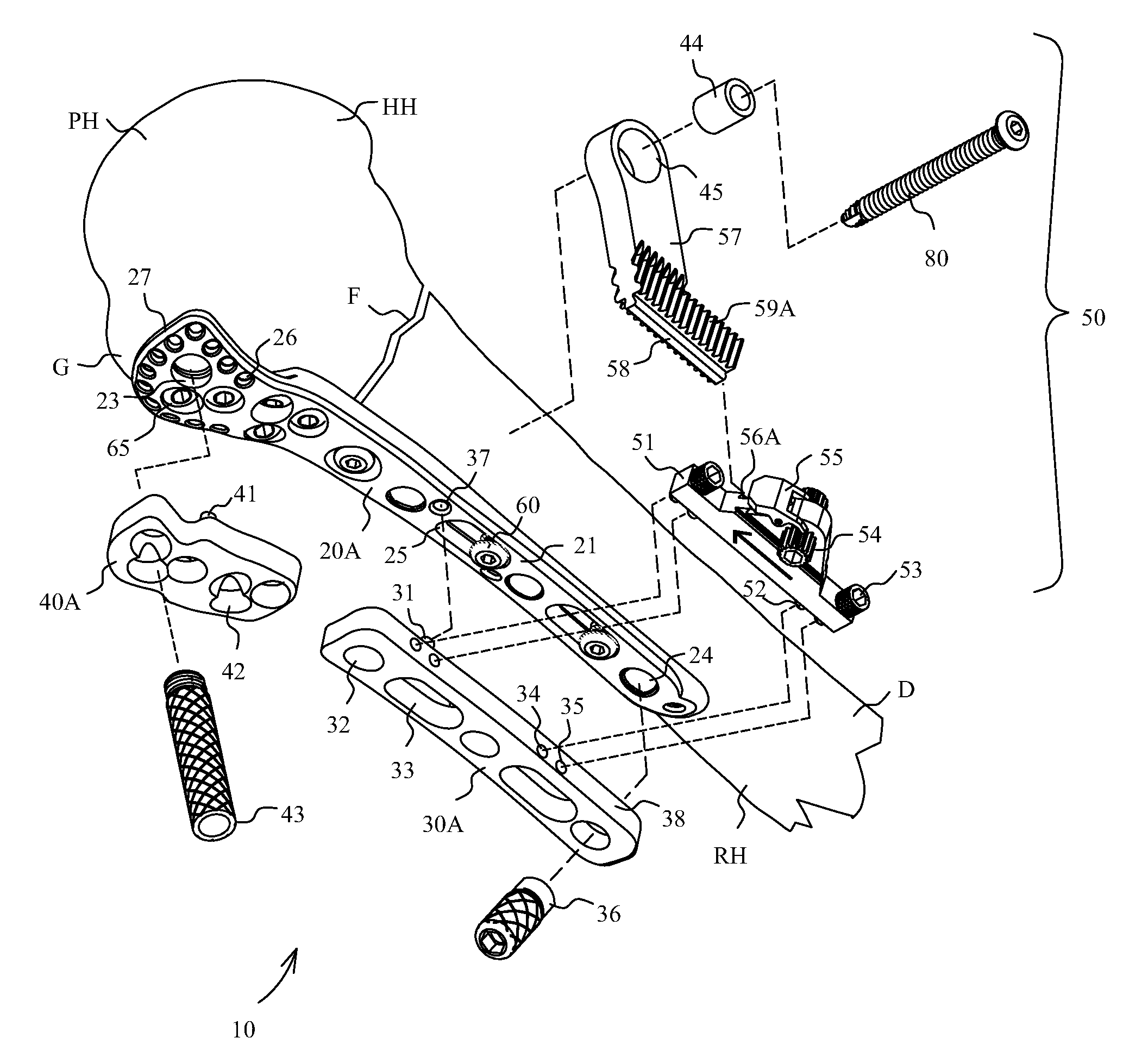 Proximal humerus fracture repair plate and system