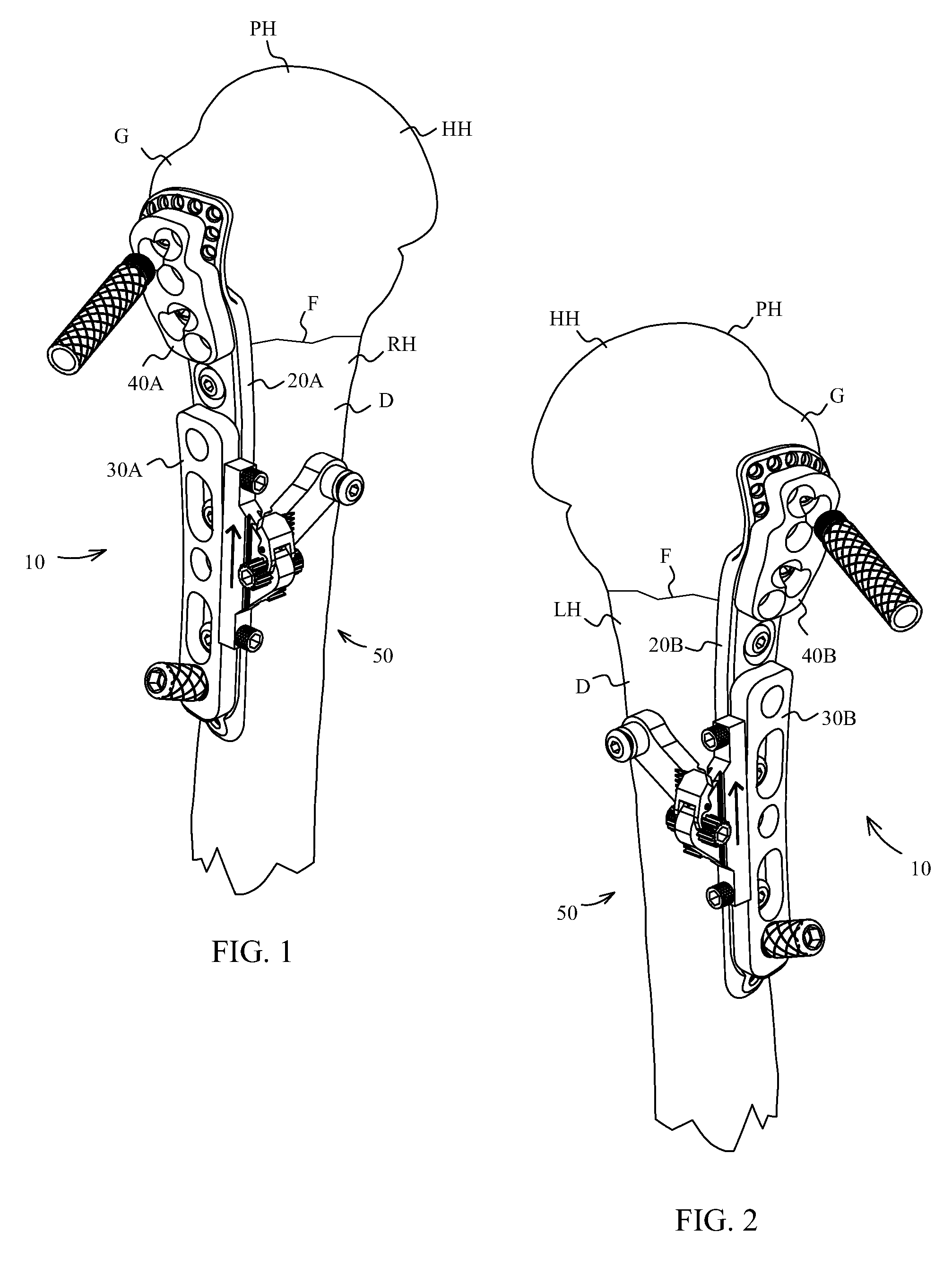 Proximal humerus fracture repair plate and system