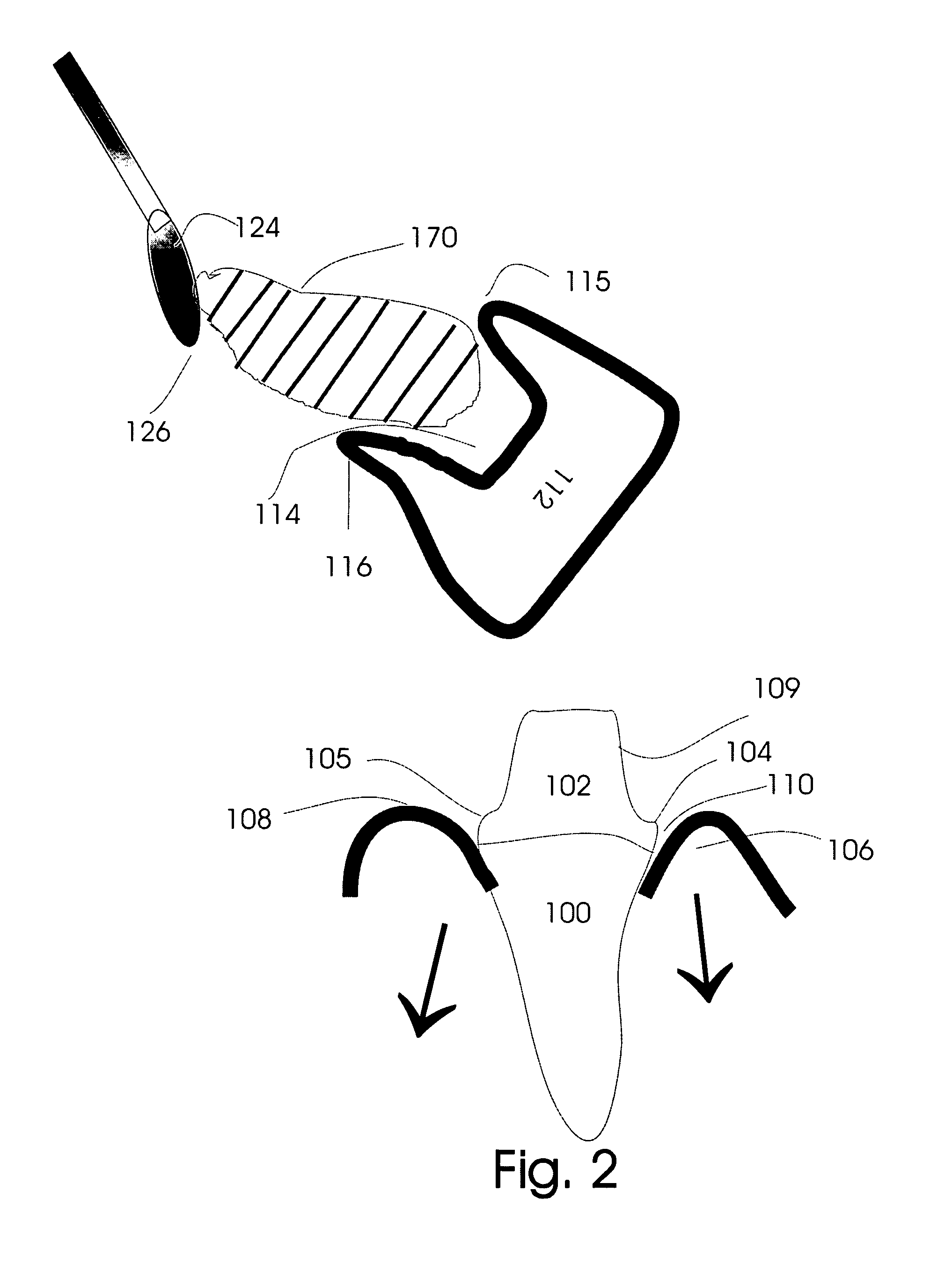 Gingival retraction device and method