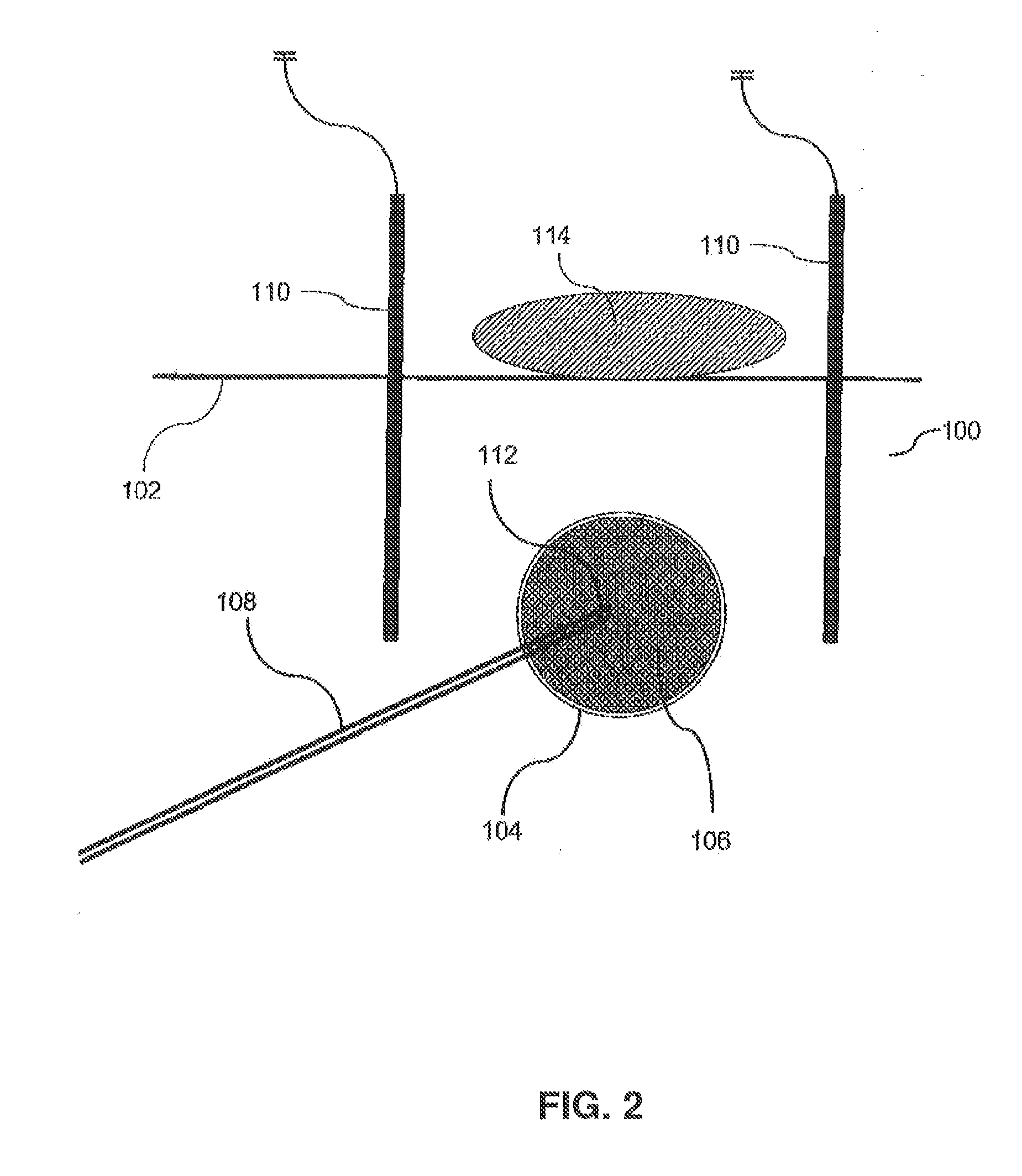 Image-guided removal and thermal therapy of breast cancer