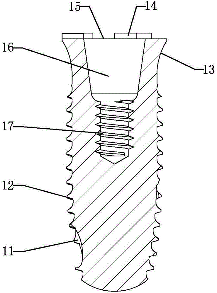 Anti-rotation implant device