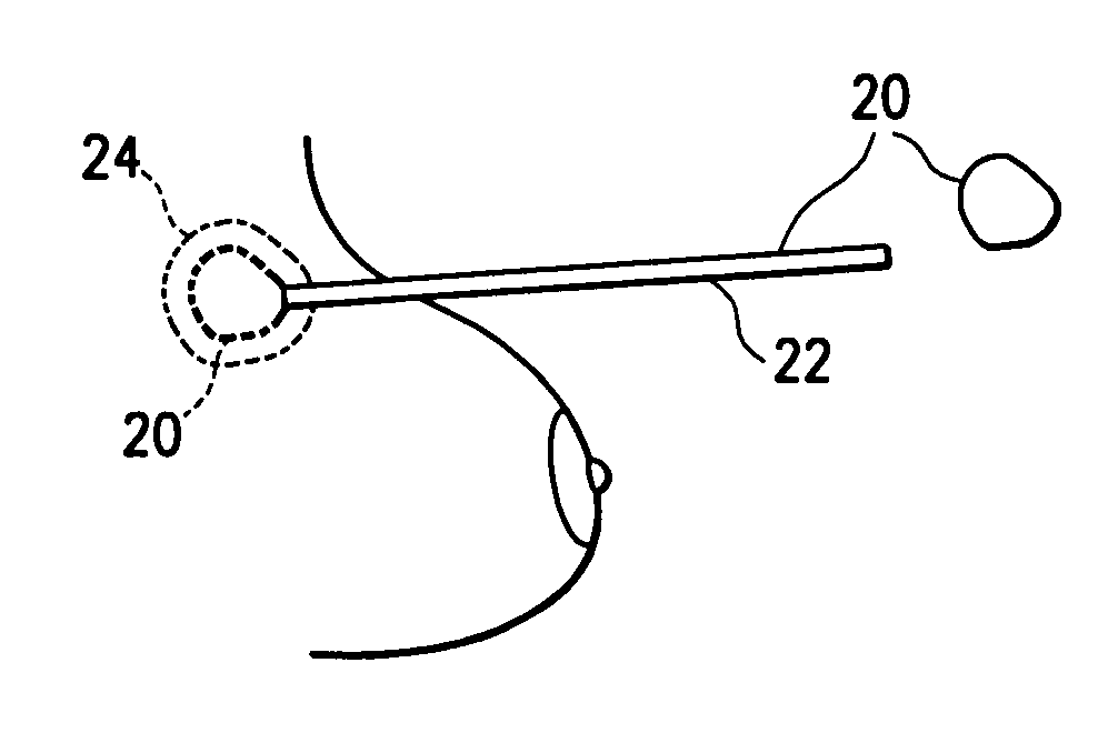 Tissue marking implant