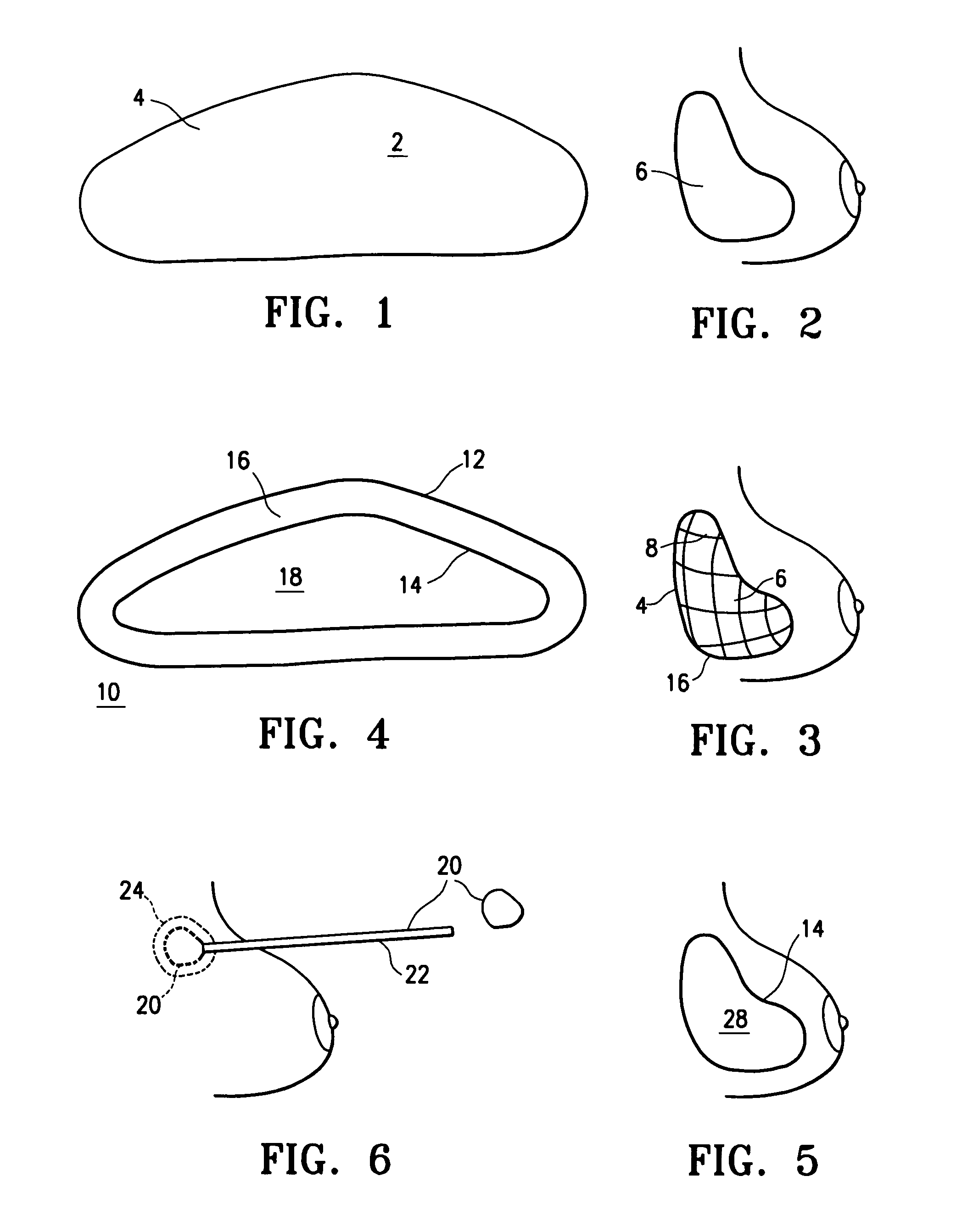 Tissue marking implant