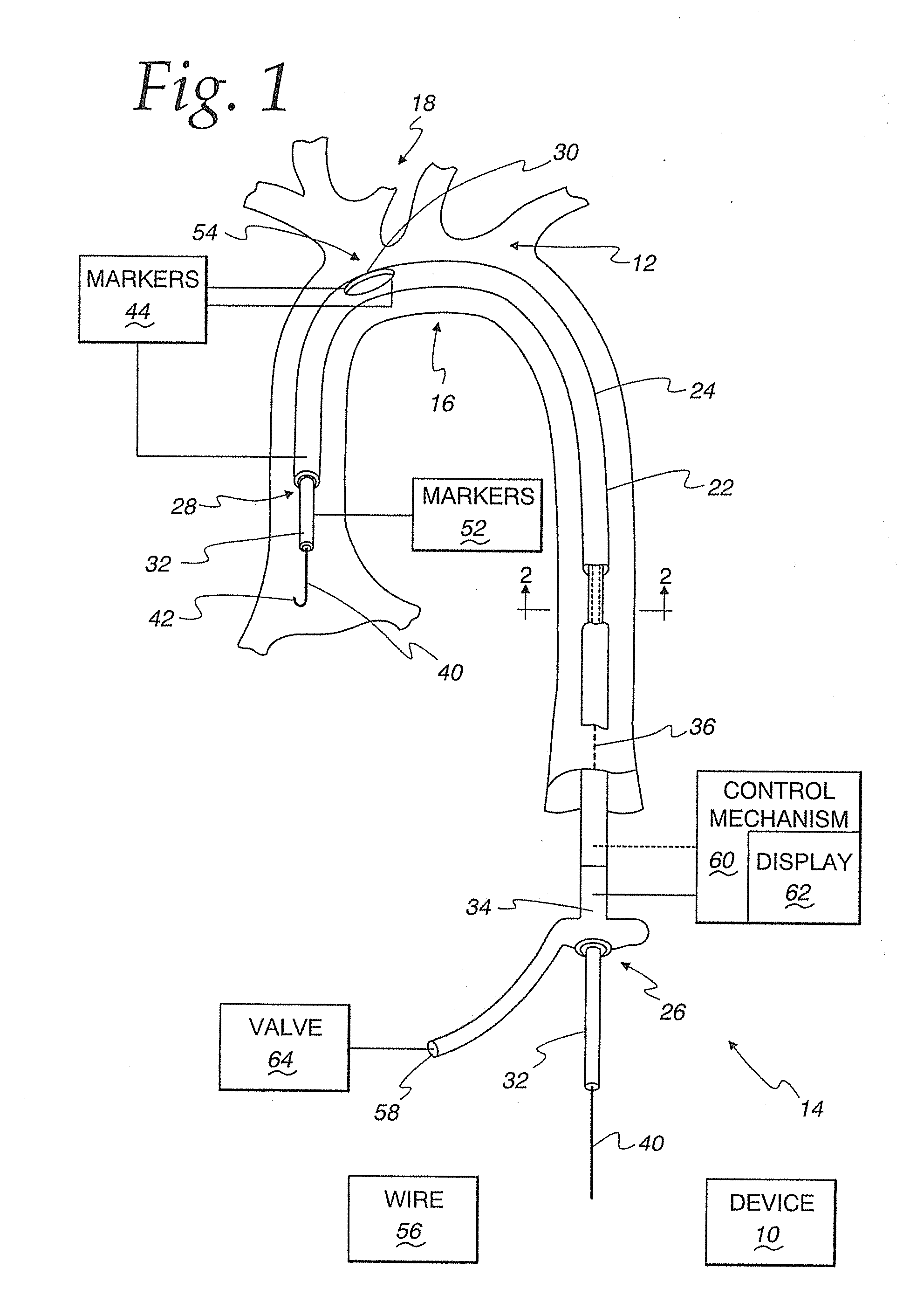 Method of controllably directing a device into a human vessel