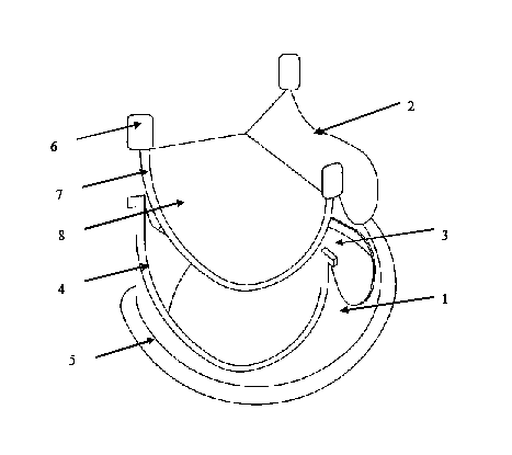 Heart bioprosthetic valve with valve leaflet capable of being repeatedly replaced through minimally invasive surgery