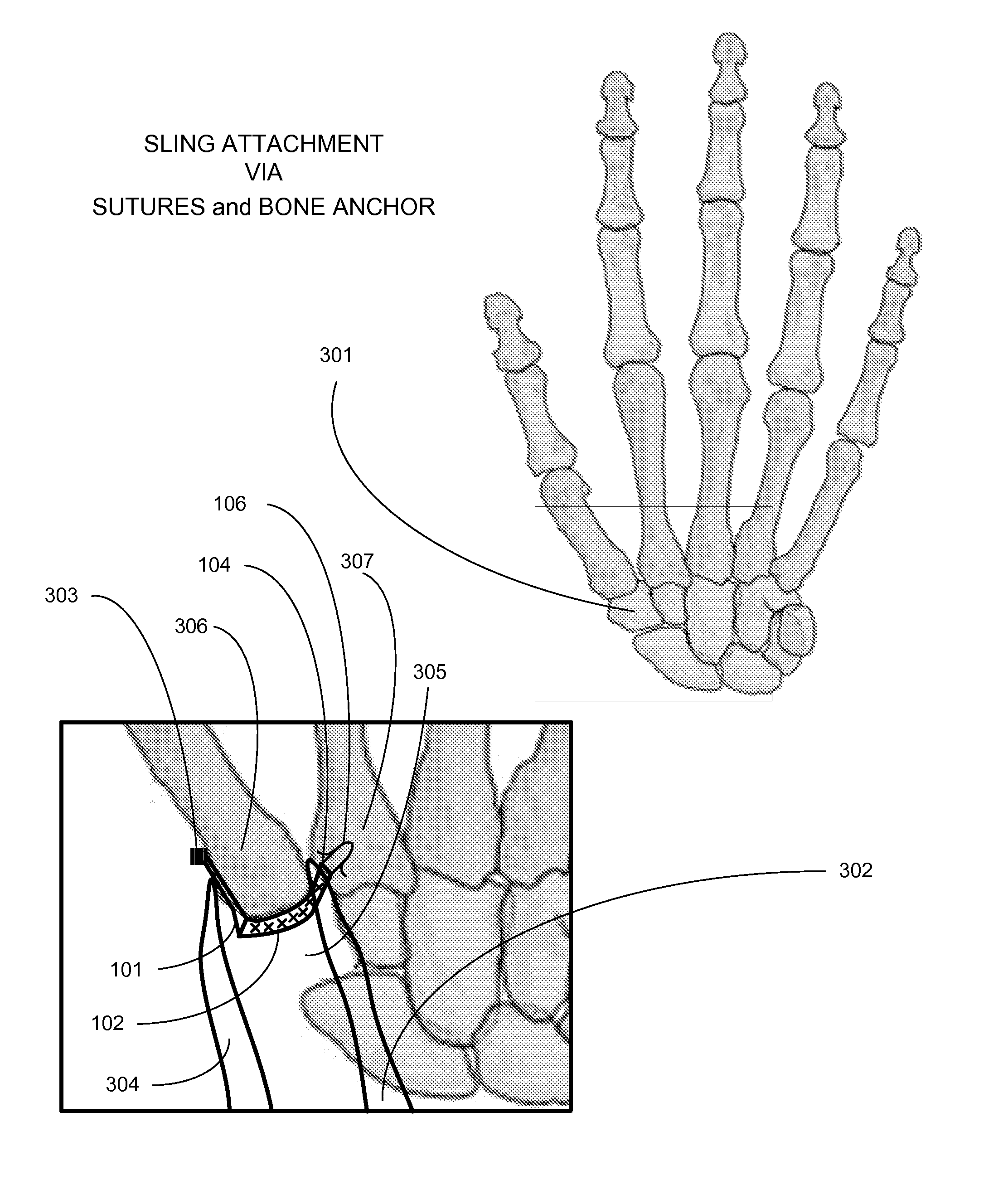 Surgical implantable stabilizer sling for basal joint arthroplasty