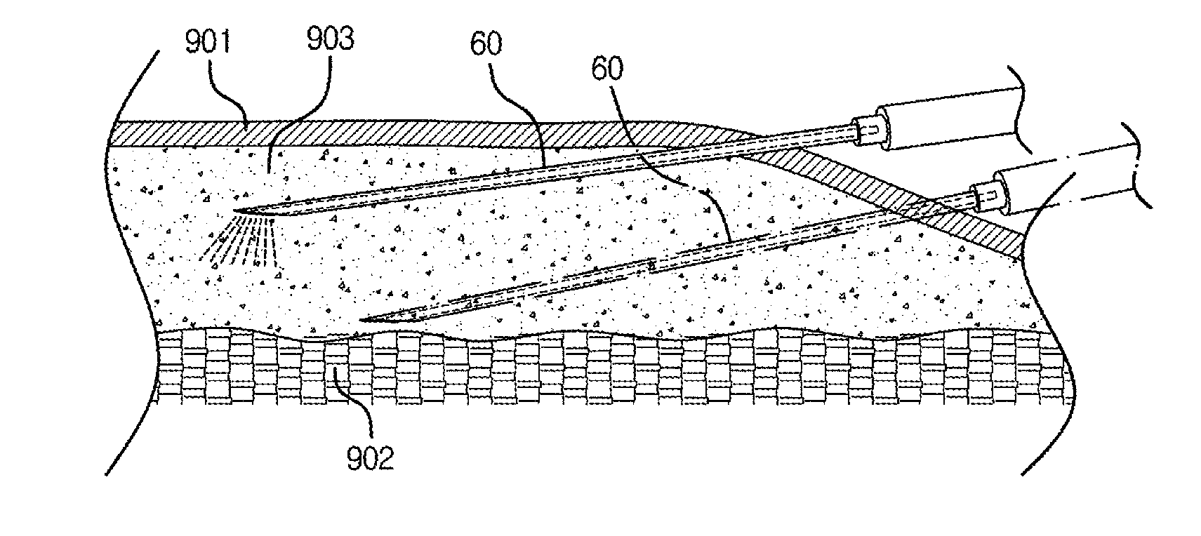 Method and apparatus for lipid removal using infrared opo laser