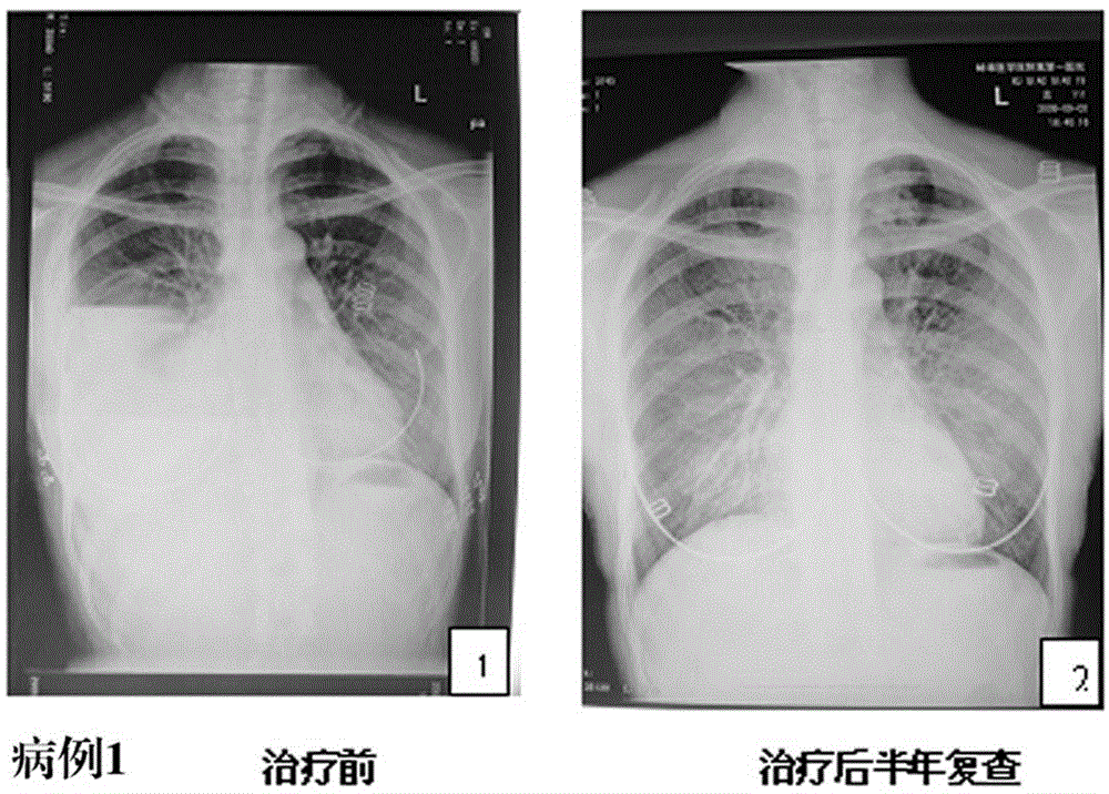 Anti-tuberculosis drug and production method thereof