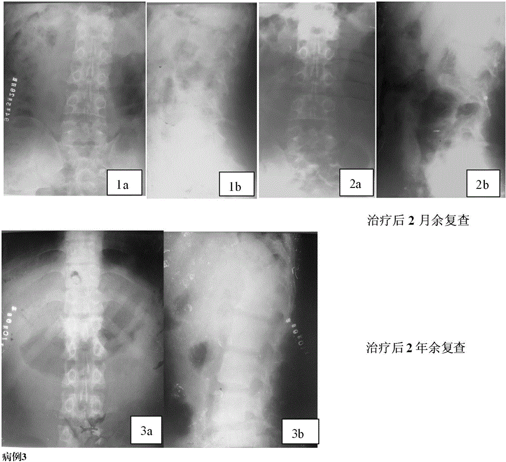 Anti-tuberculosis drug and production method thereof