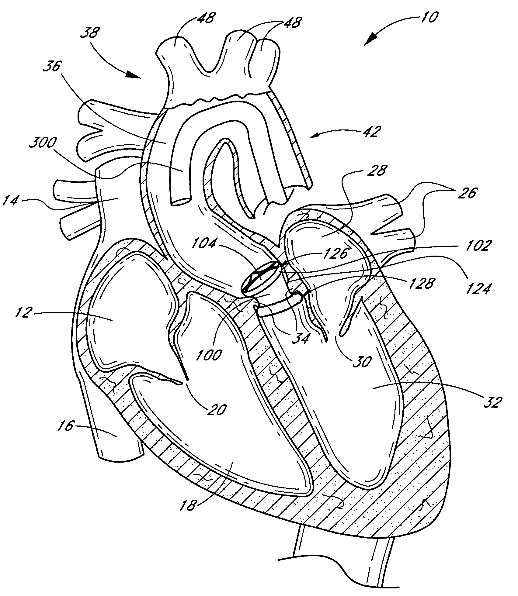 Method of in situ formation of translumenally deployable heart valve support