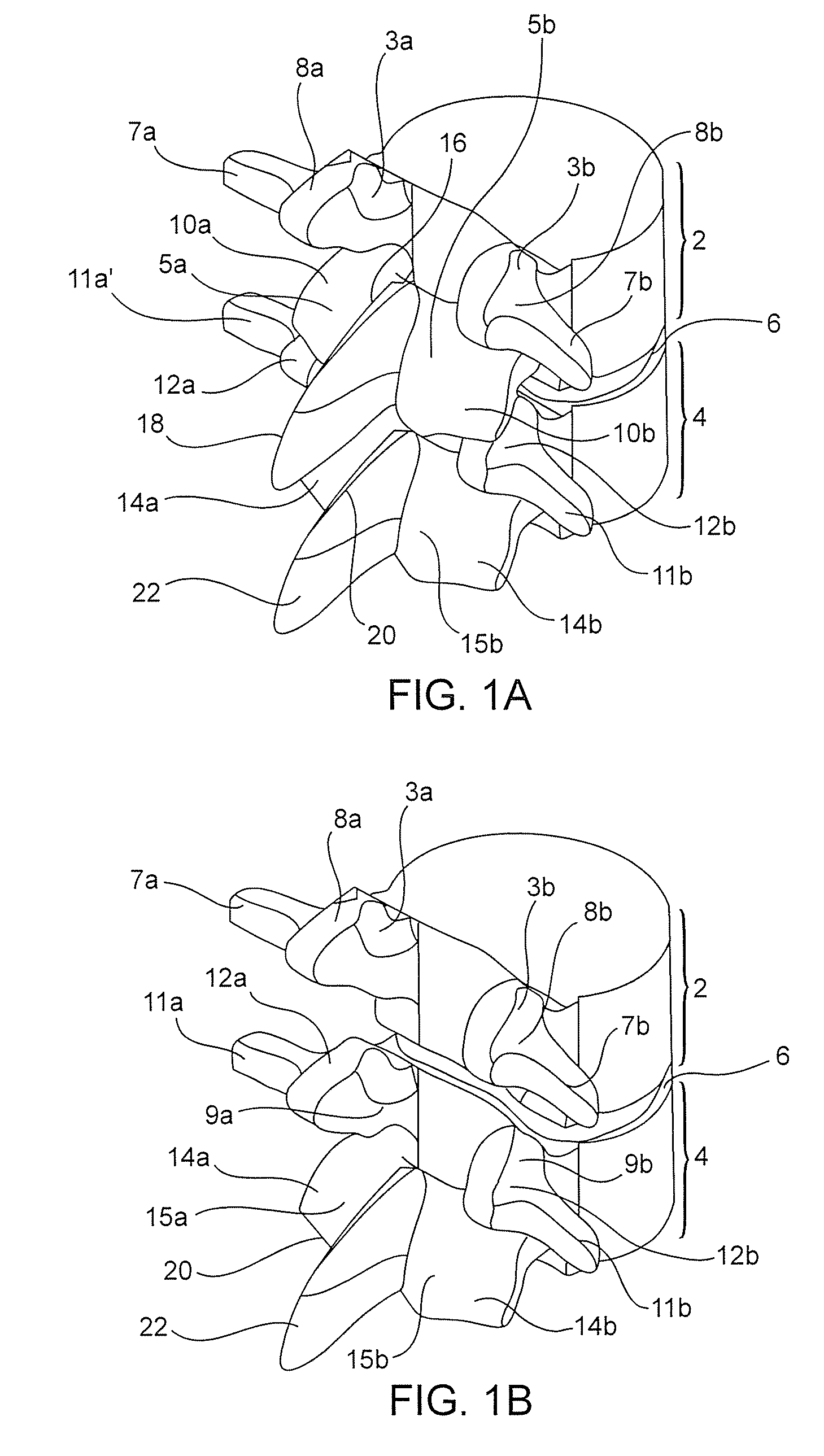 Systems and methods for stabilization of bone structures