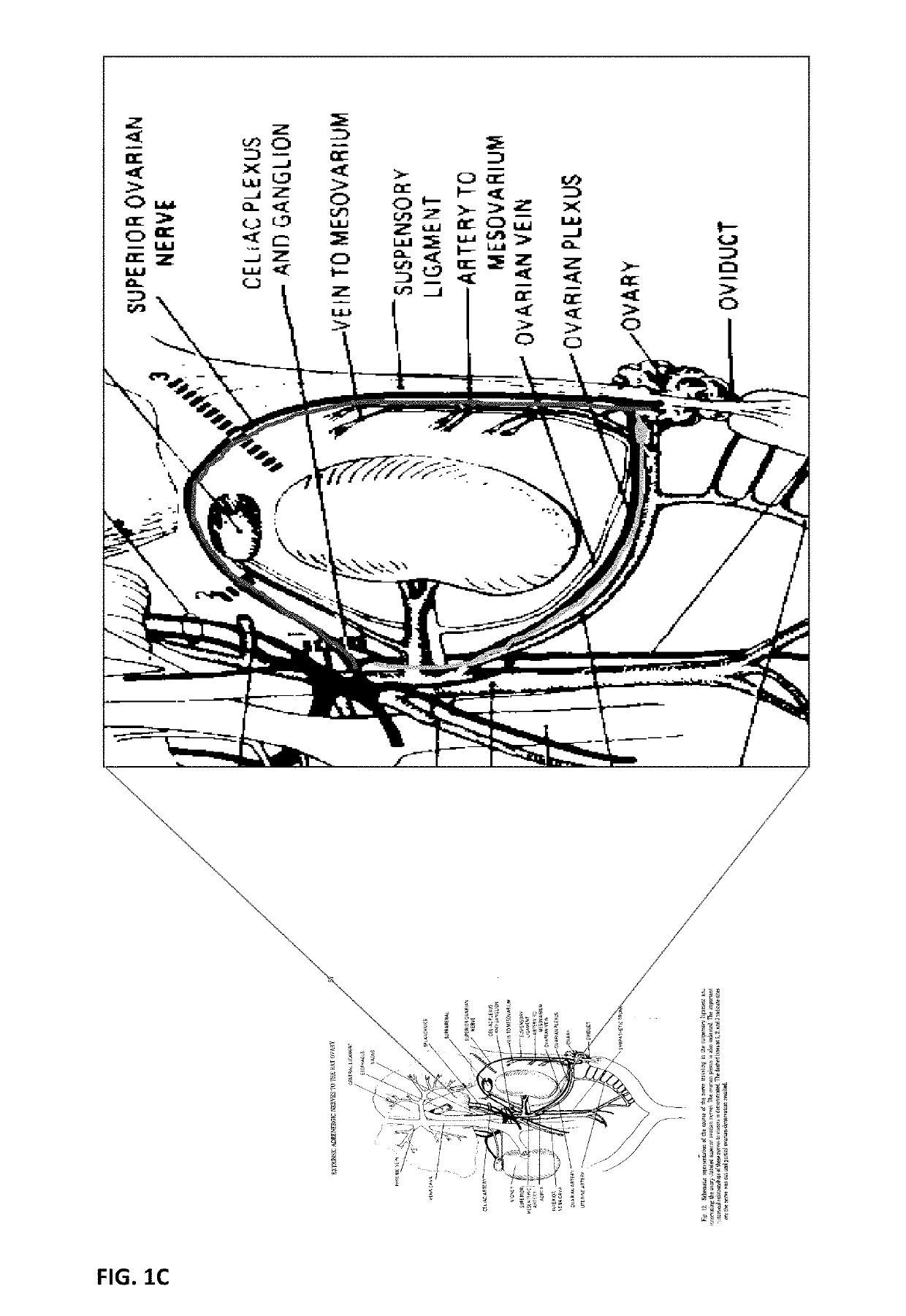 Neuromodulation device