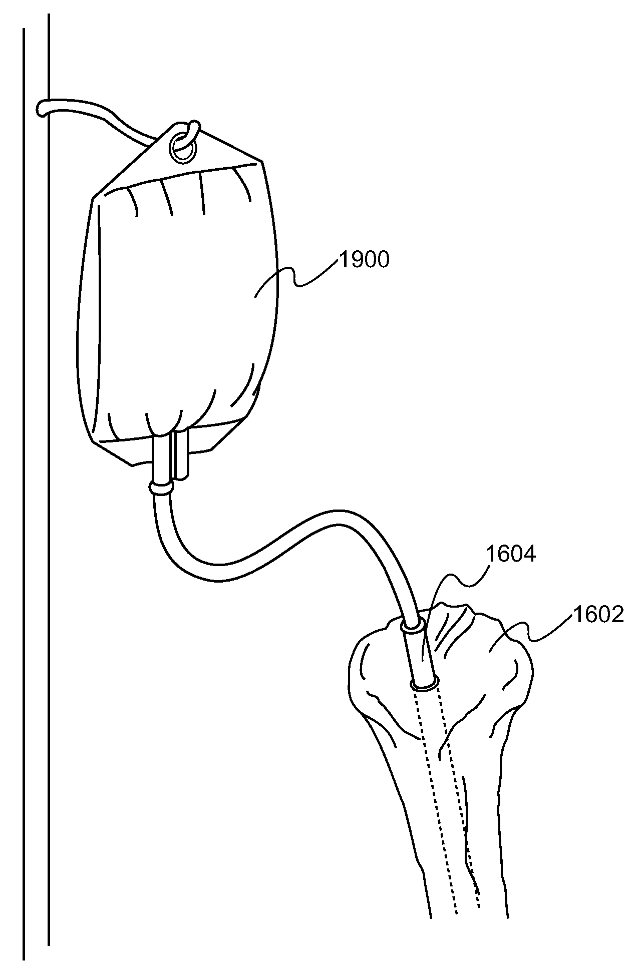 Method and device for delivering medicine to bone