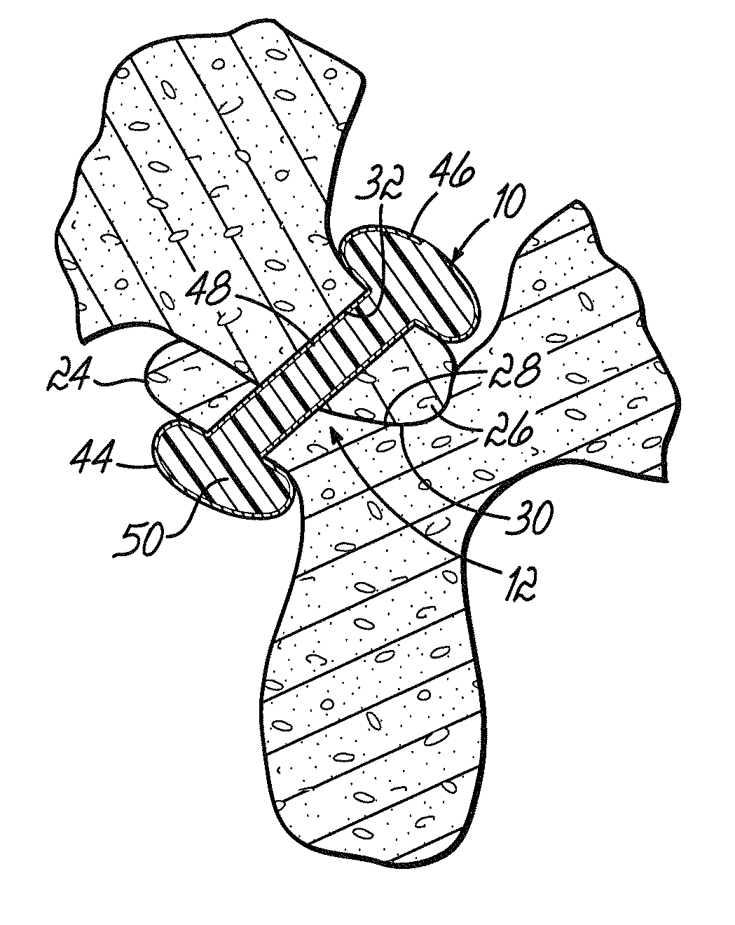 Method for stabilizing a facet joint