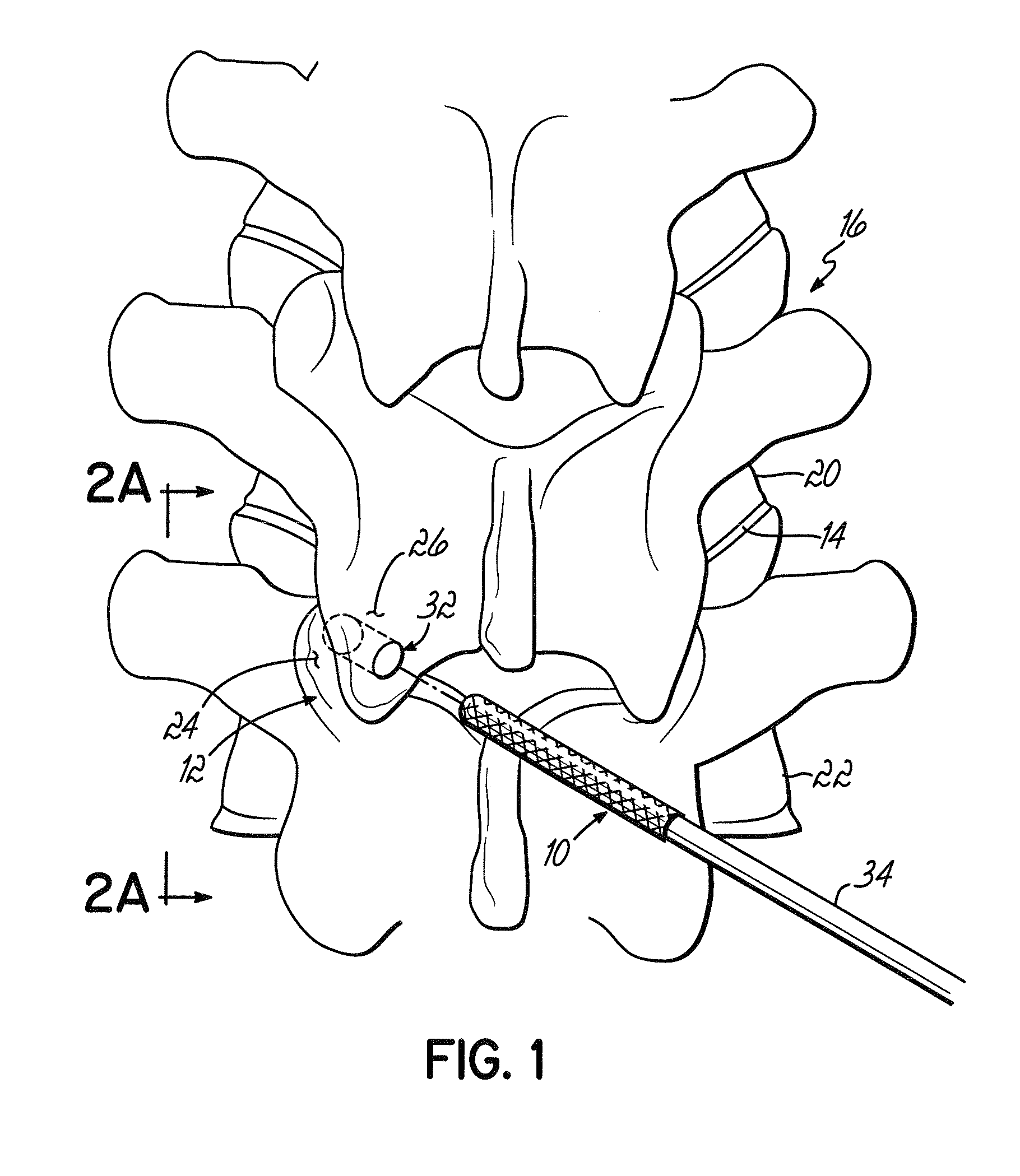 Method for stabilizing a facet joint