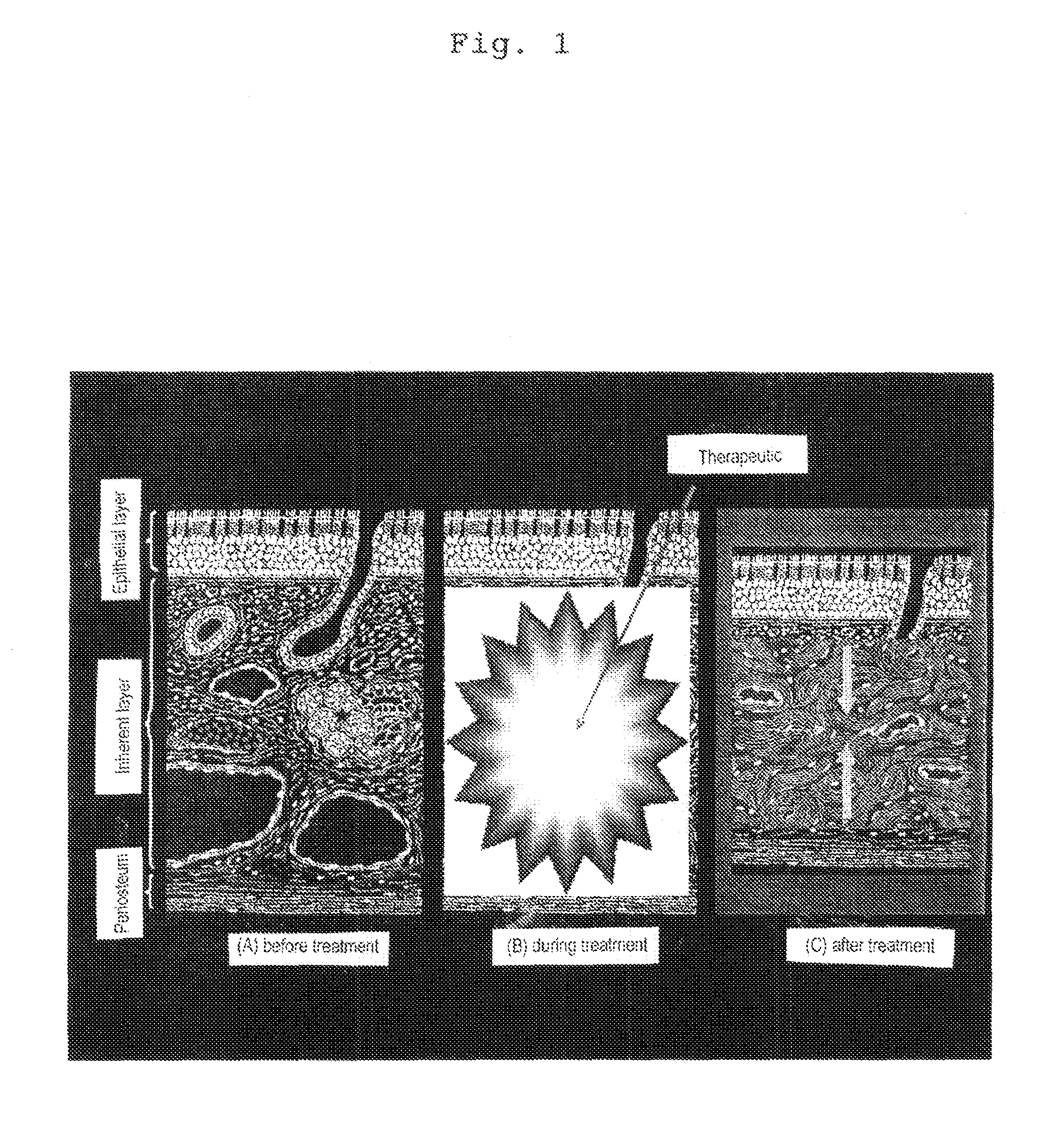 Therapeutic causing contraction of mucosal tissue, method of treating diseases relating to mucosal tissues, injector and therapeutic set