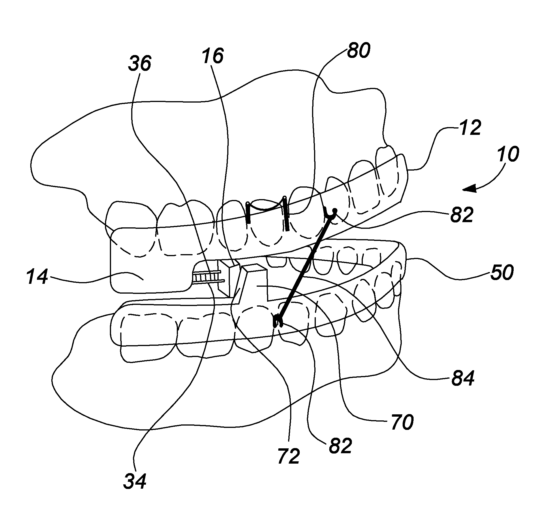 Apparatus for the prevention of sleep apnea