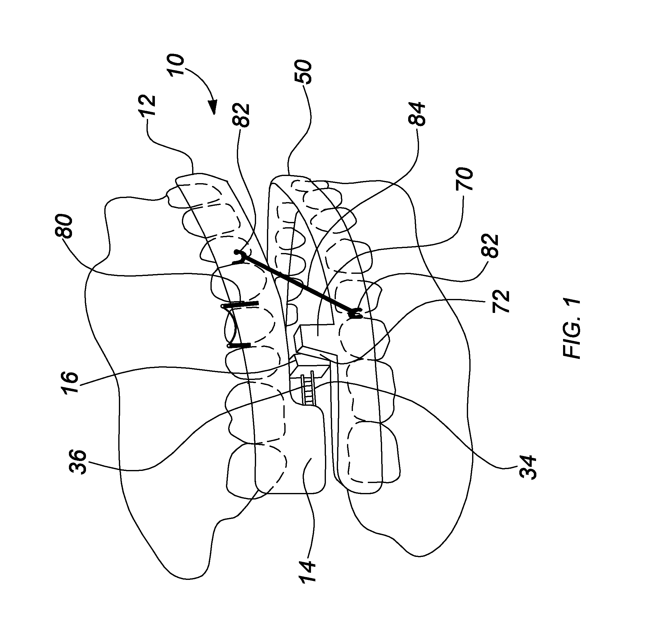 Apparatus for the prevention of sleep apnea